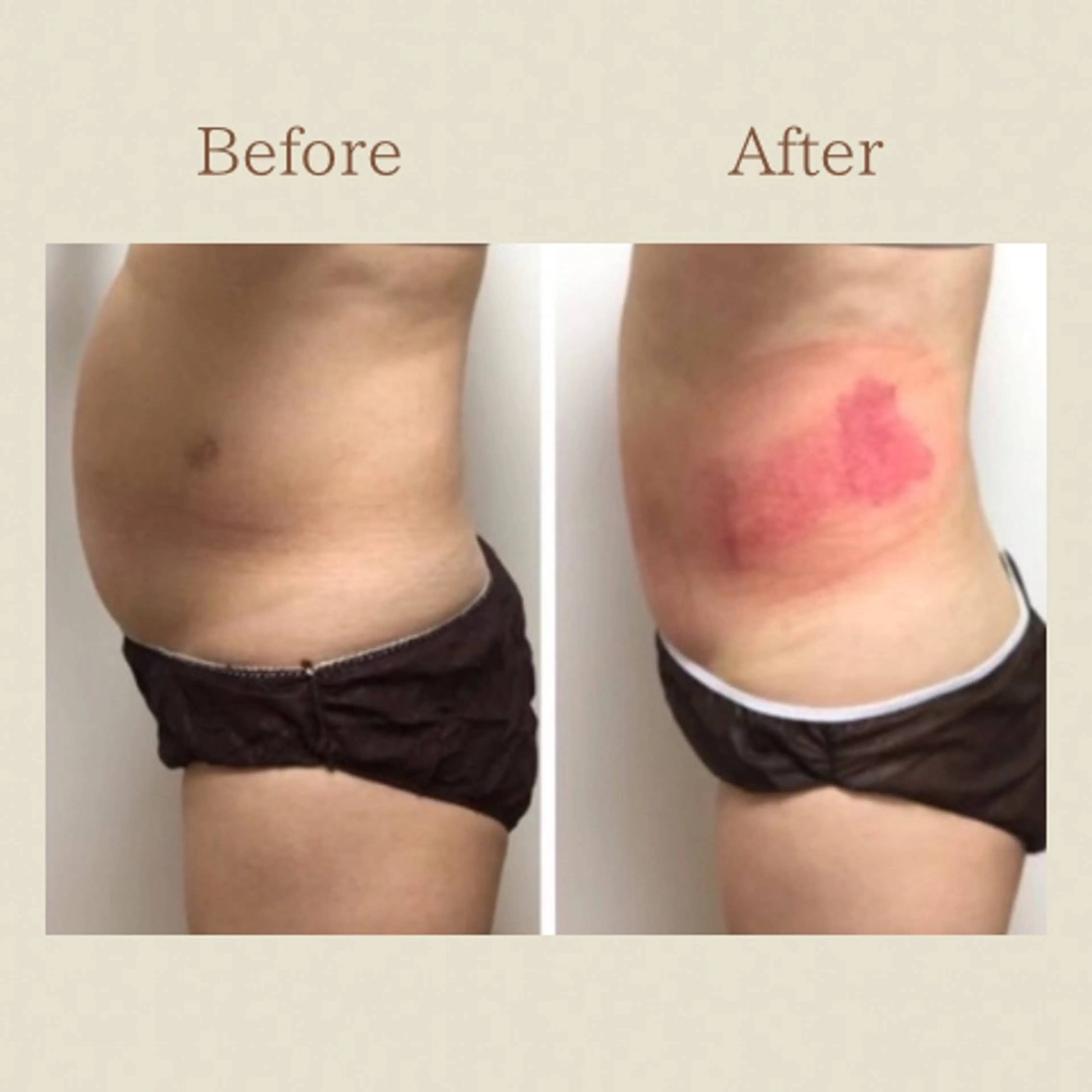 お腹痩せエステ Flat BELLY 恵比寿所属・【腸もみ/脂肪冷却】 お腹エステ/恵比寿のエステ・リラクイメージ