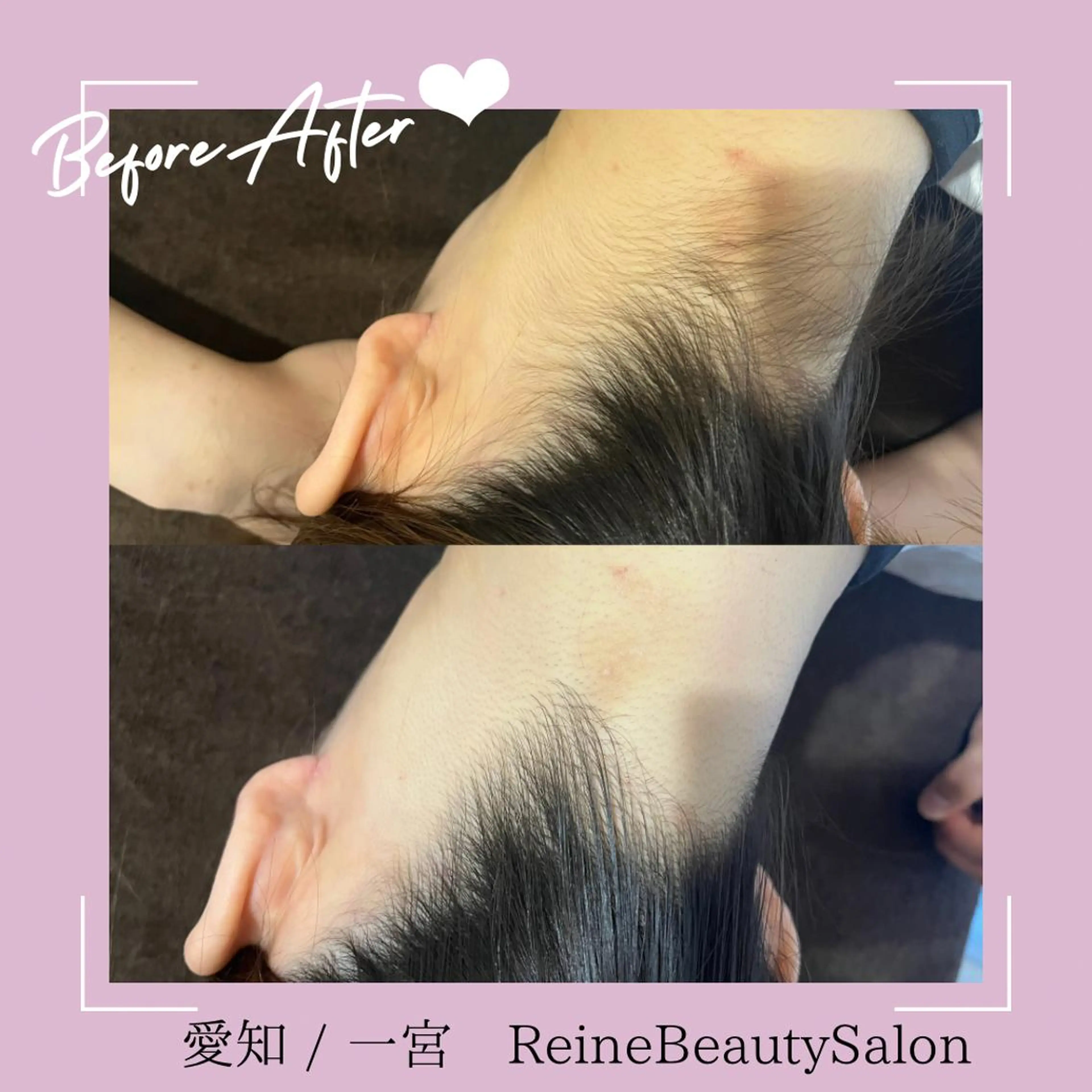 脱毛 Reine BeautySalon所属・毛穴/シミ肝斑/脱毛 横山梨里のエステ・リラクイメージ