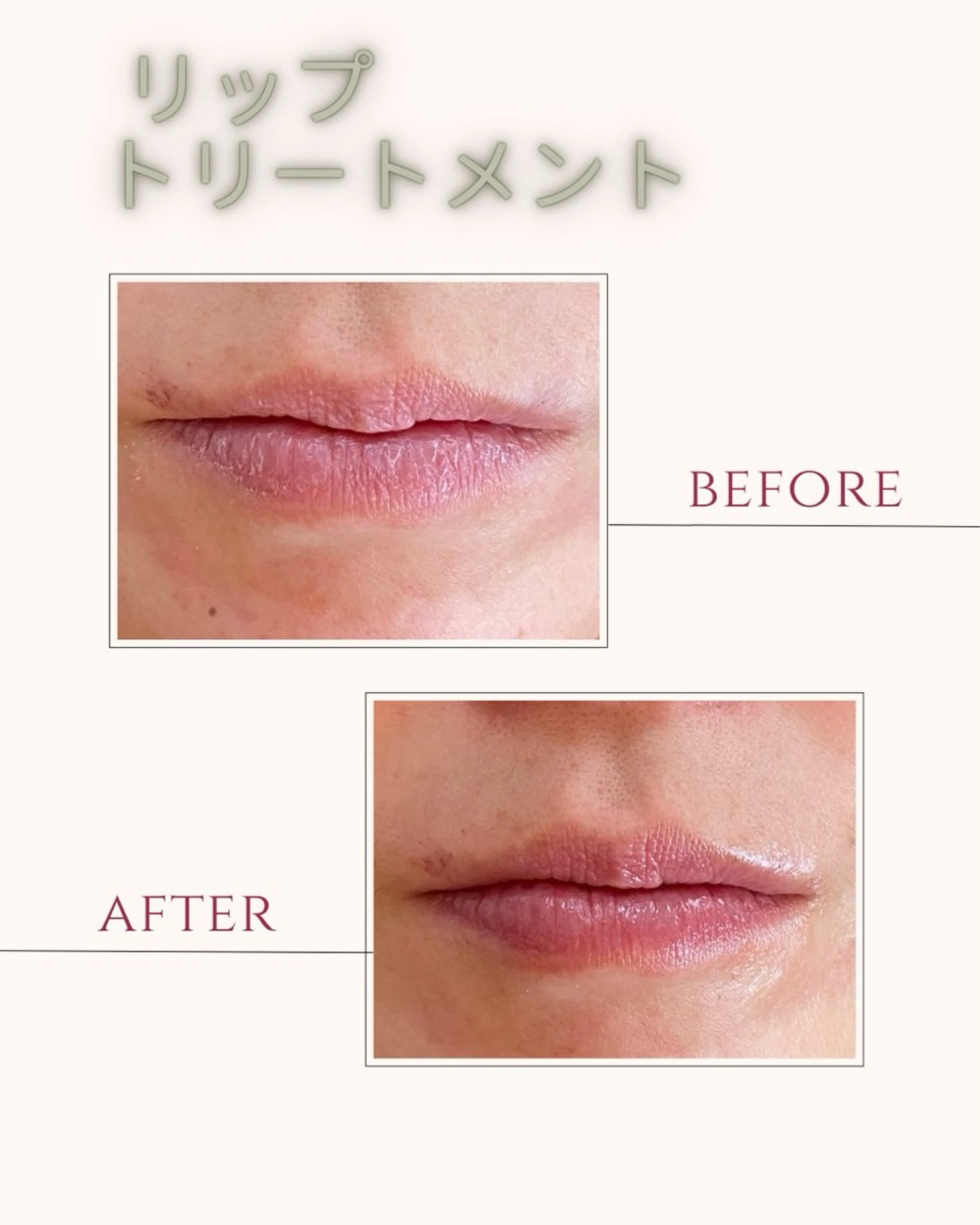 リップトリートメントの写真