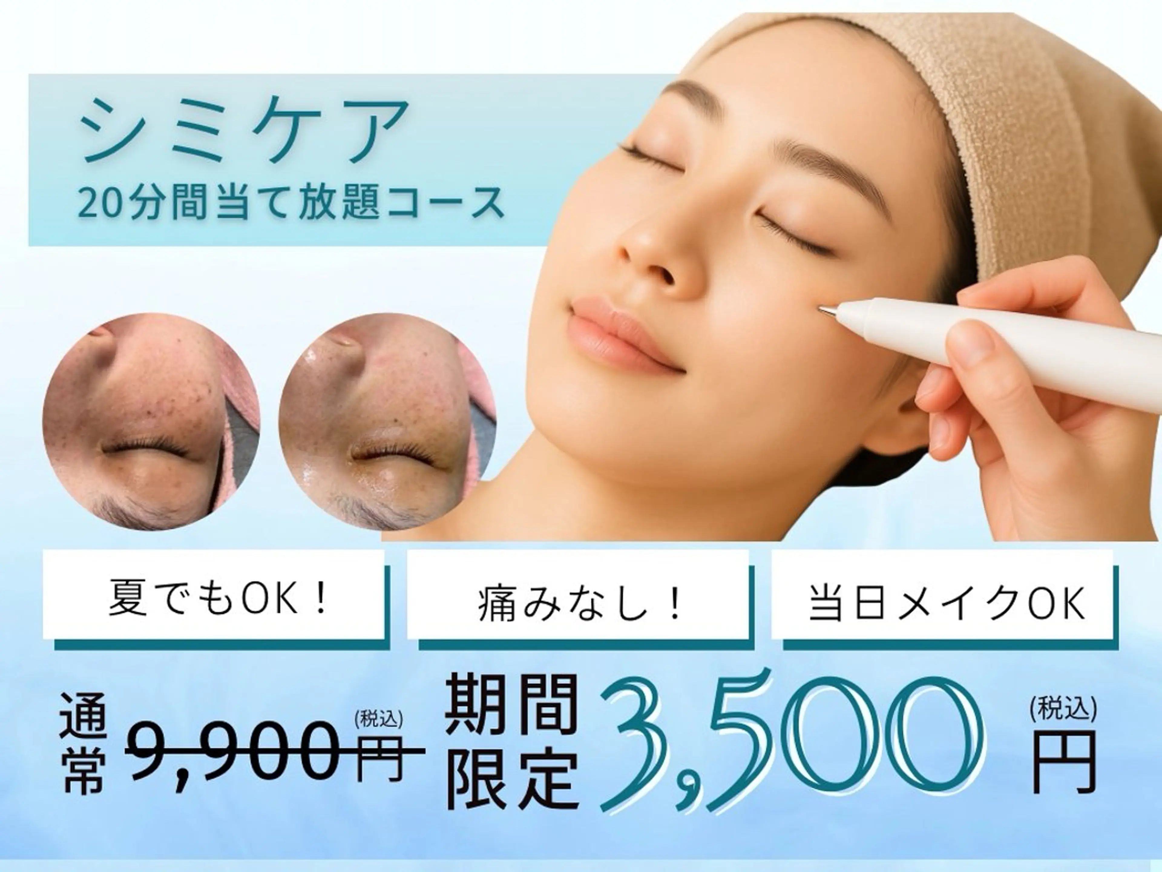 【本日限定❗️破格につき1名様限定❗️】低周波シミ取り20分間当て放題◎シミ・ニキビ跡・色素沈着がポロッと剥離！の写真