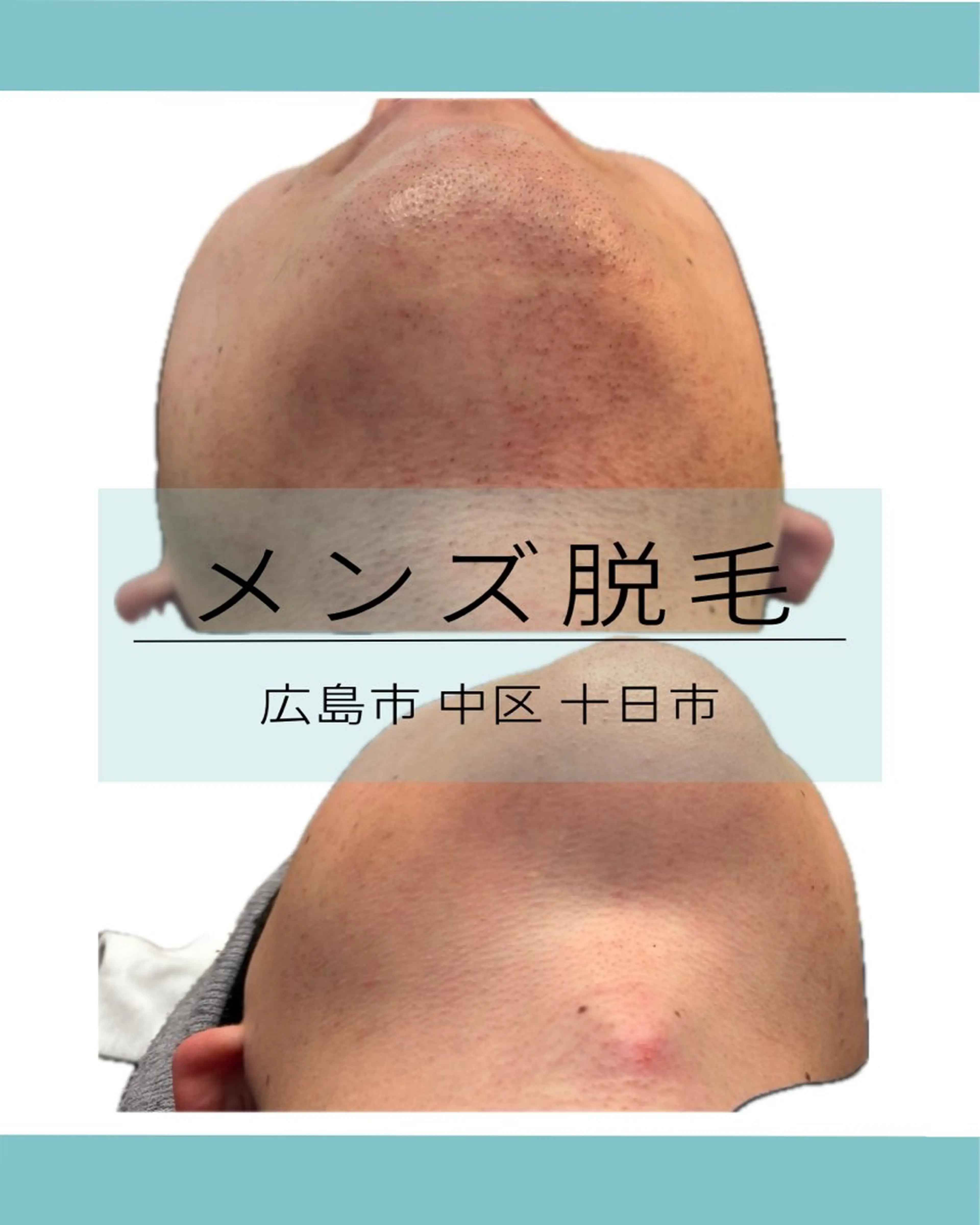 メンズ 脱毛 宮崎 みおのエステ・リラクイメージ