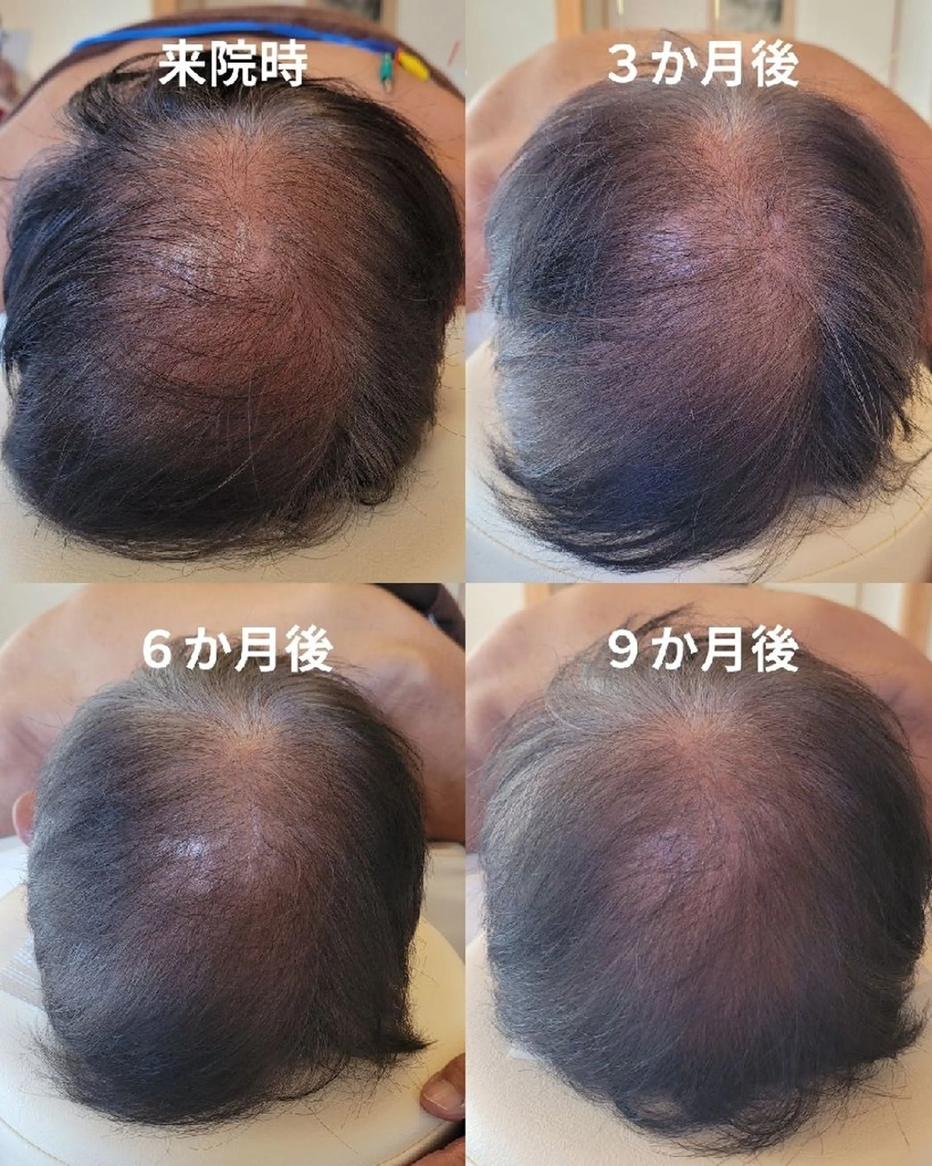 [薄化・抜け毛特化]初回育毛鍼の写真