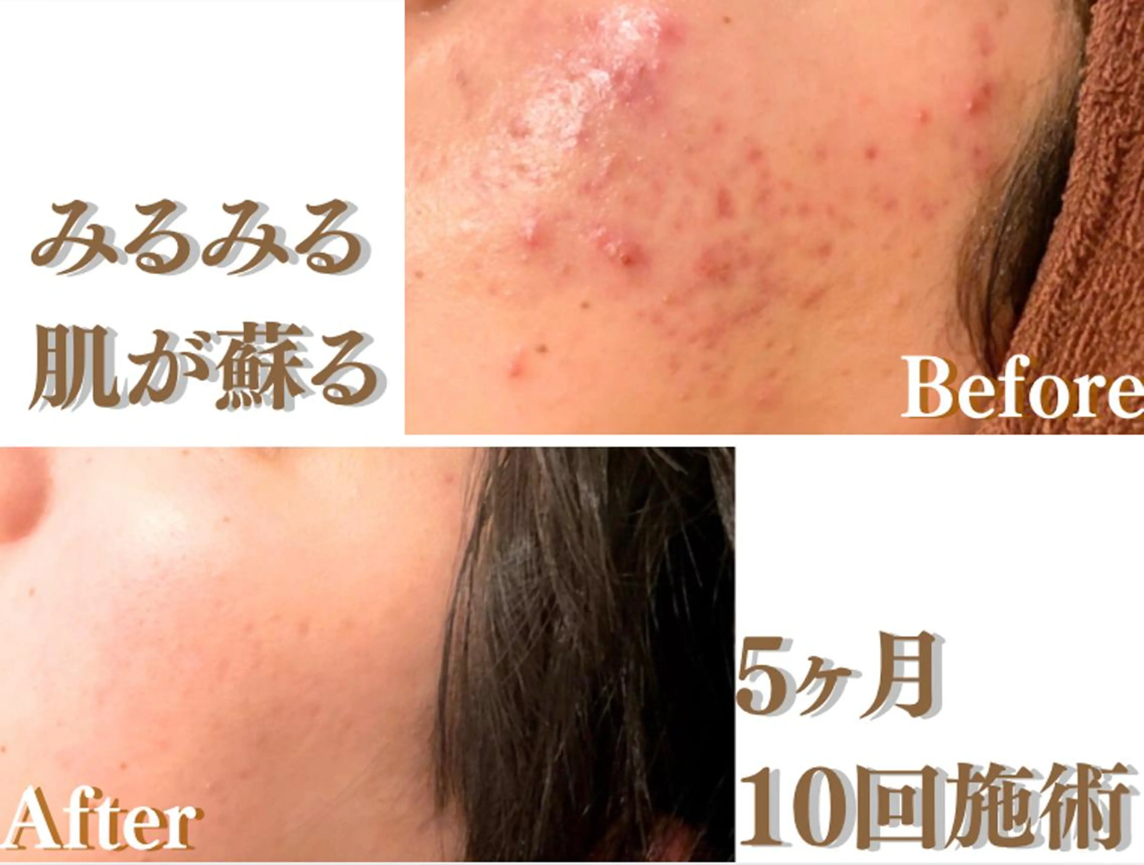 エステ リラク 皮膚科より効果あり ⁉️最短ニキビ改善のエステ・リラクイメージ