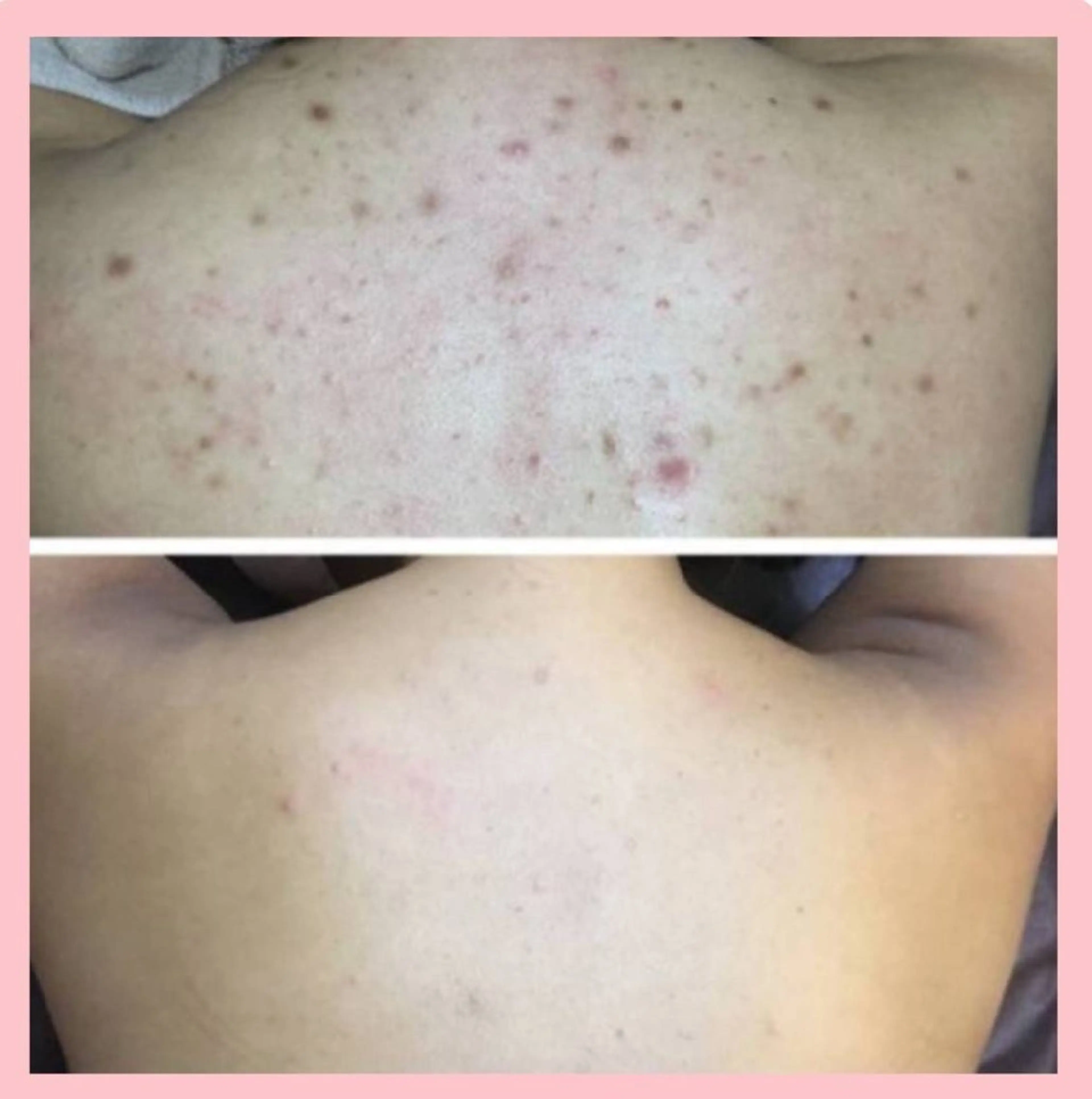 Bodyハーブピーリング🌿(ハード剥離あり)背中、腰、二の腕、お尻、デコルテ等🩵吹き出物、毛穴のザラつき、色跡に🩵の写真