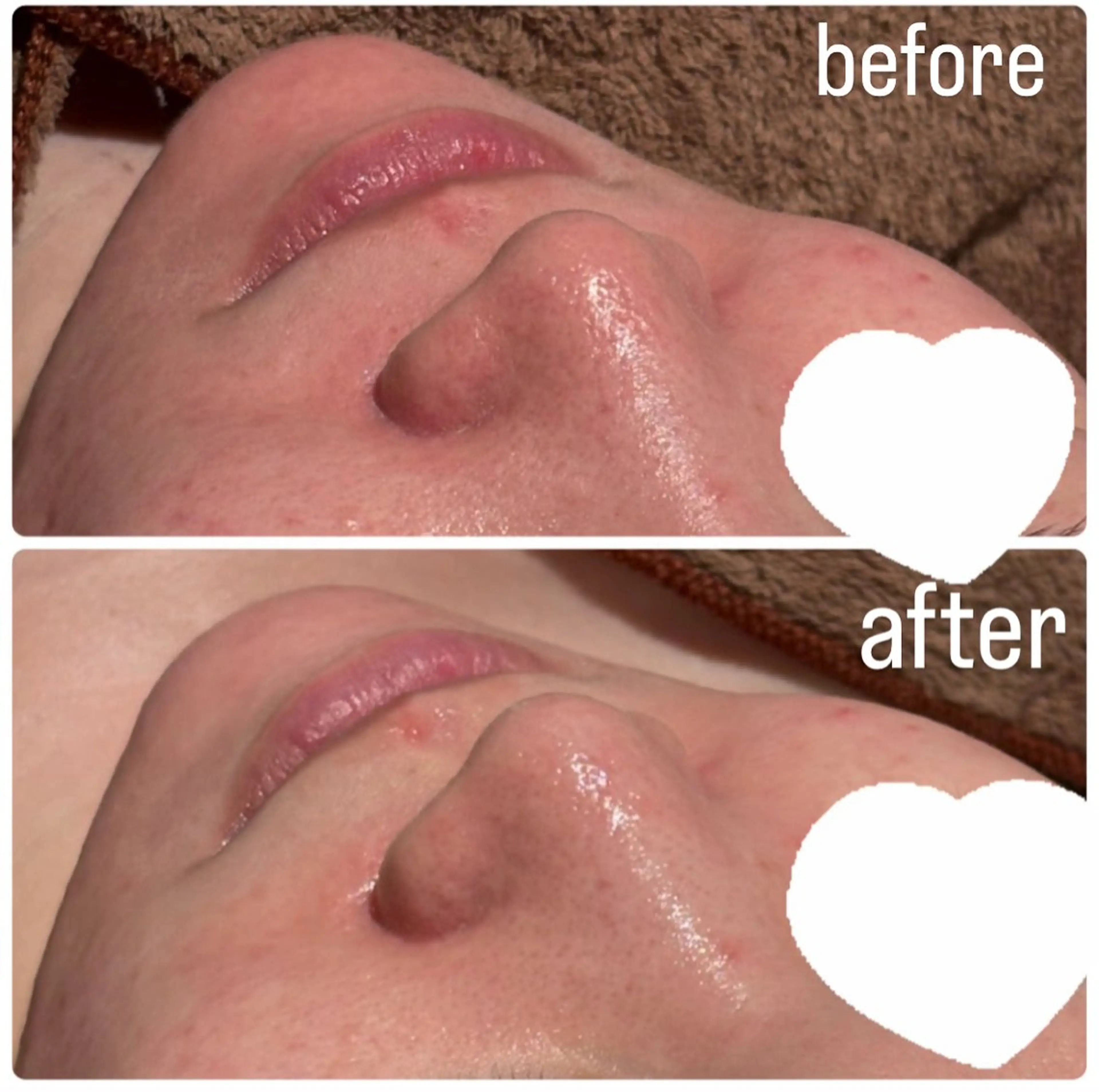 【学生＆20代前半限定🎀】肌荒れケアフェイシャル✨の写真