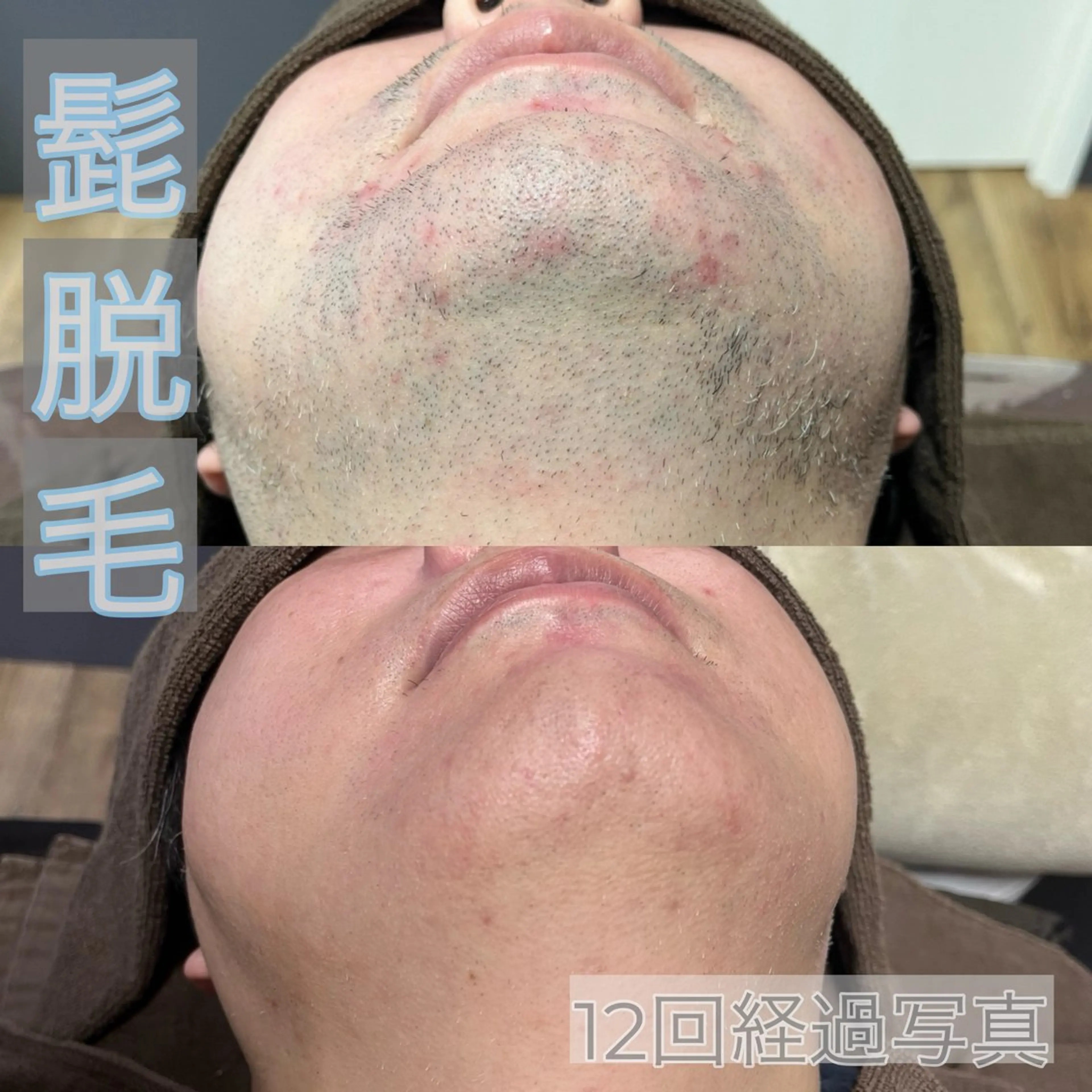 【メンズ】👨🏻ヒゲ脱毛3回セット！の写真