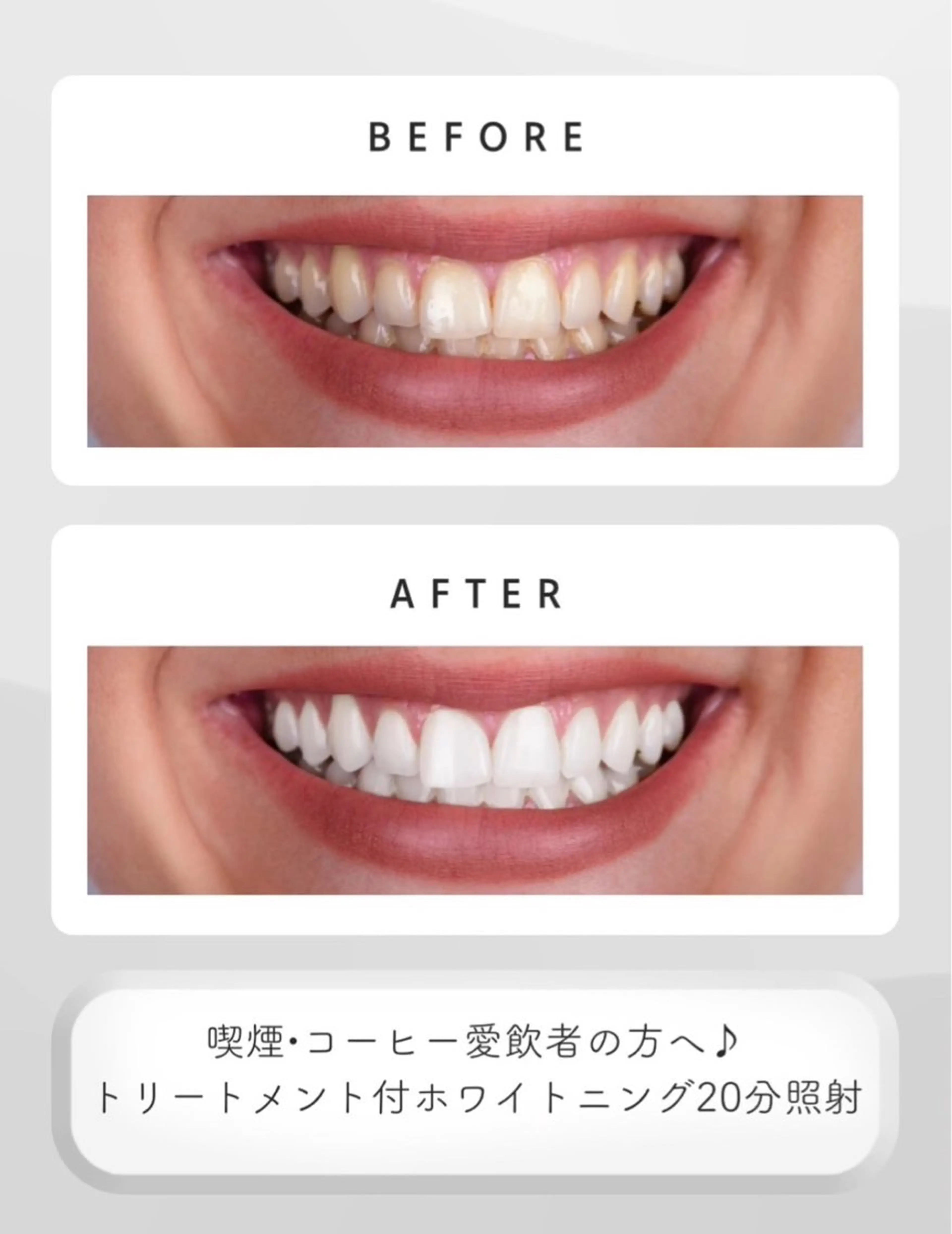 【愛煙家・コーヒー愛飲者】トリートメント付きホワイトニングの写真