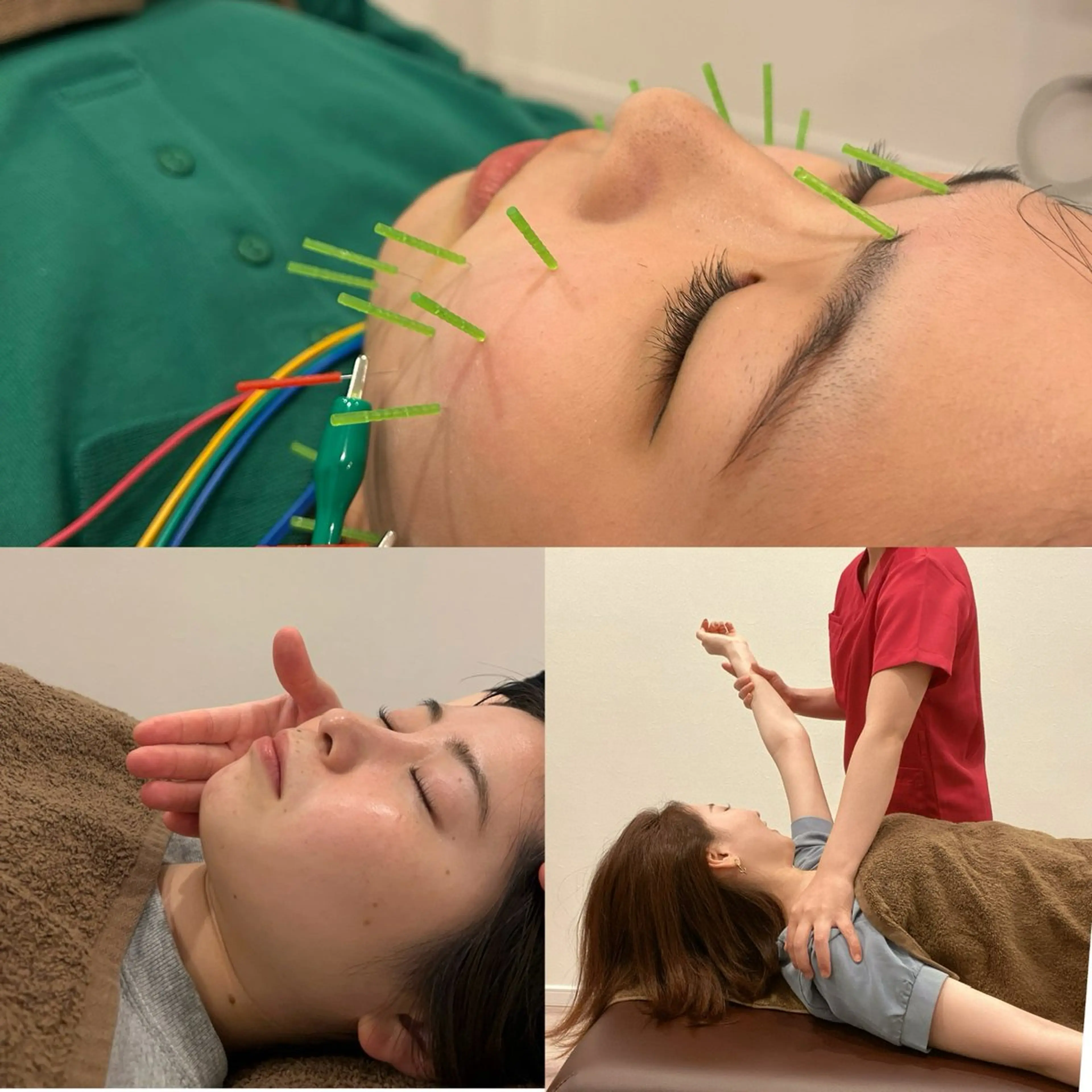 【美肌&疲労回復】美容鍼灸+身体の鍼灸でWアプローチ！（眼精疲労・肩こり）の写真
