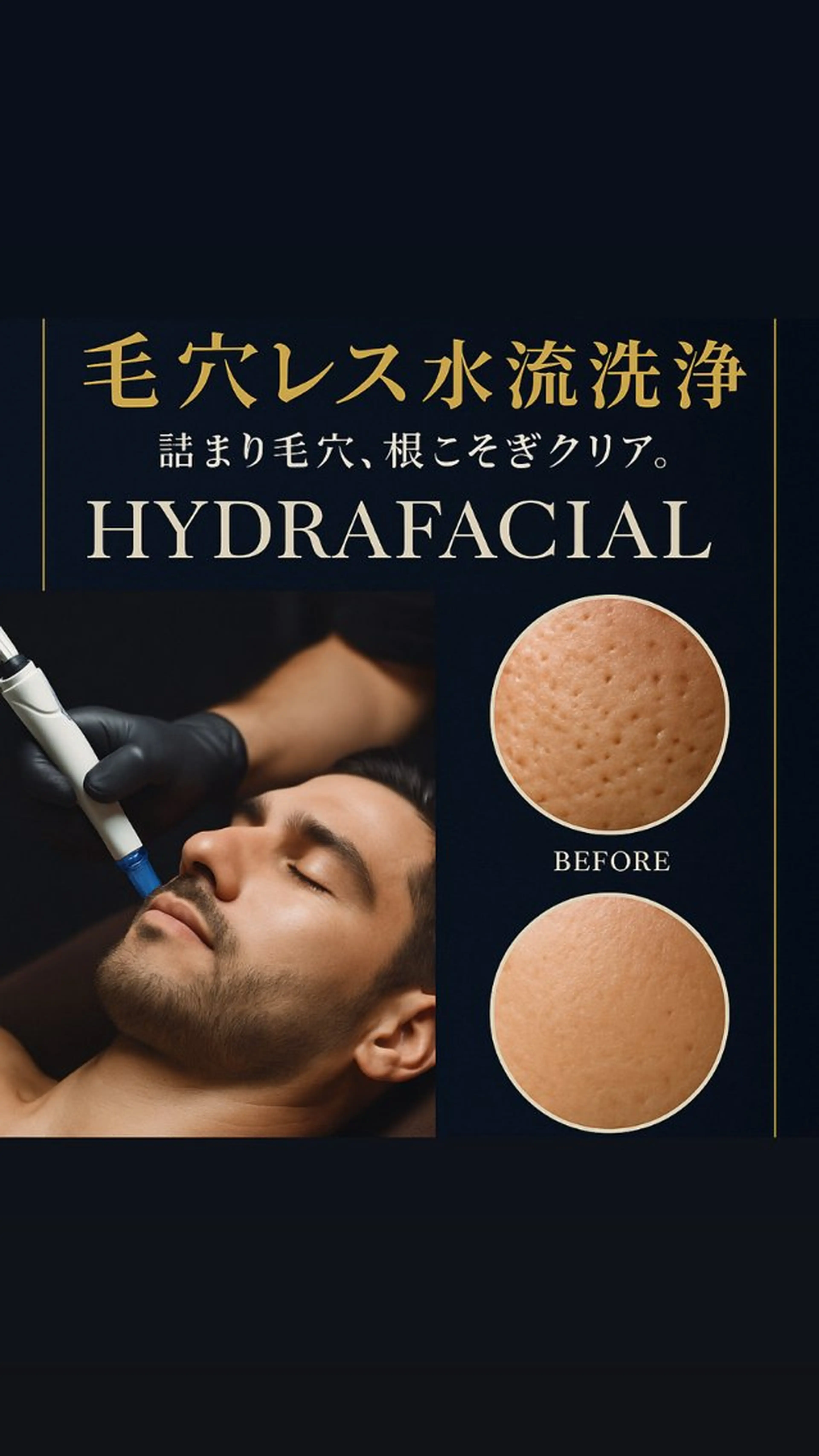 【ミニモSALE40%OFF】水素洗浄で毛穴スカッと！・ハイドロフェイシャル＋鎮静パック付き♪の写真