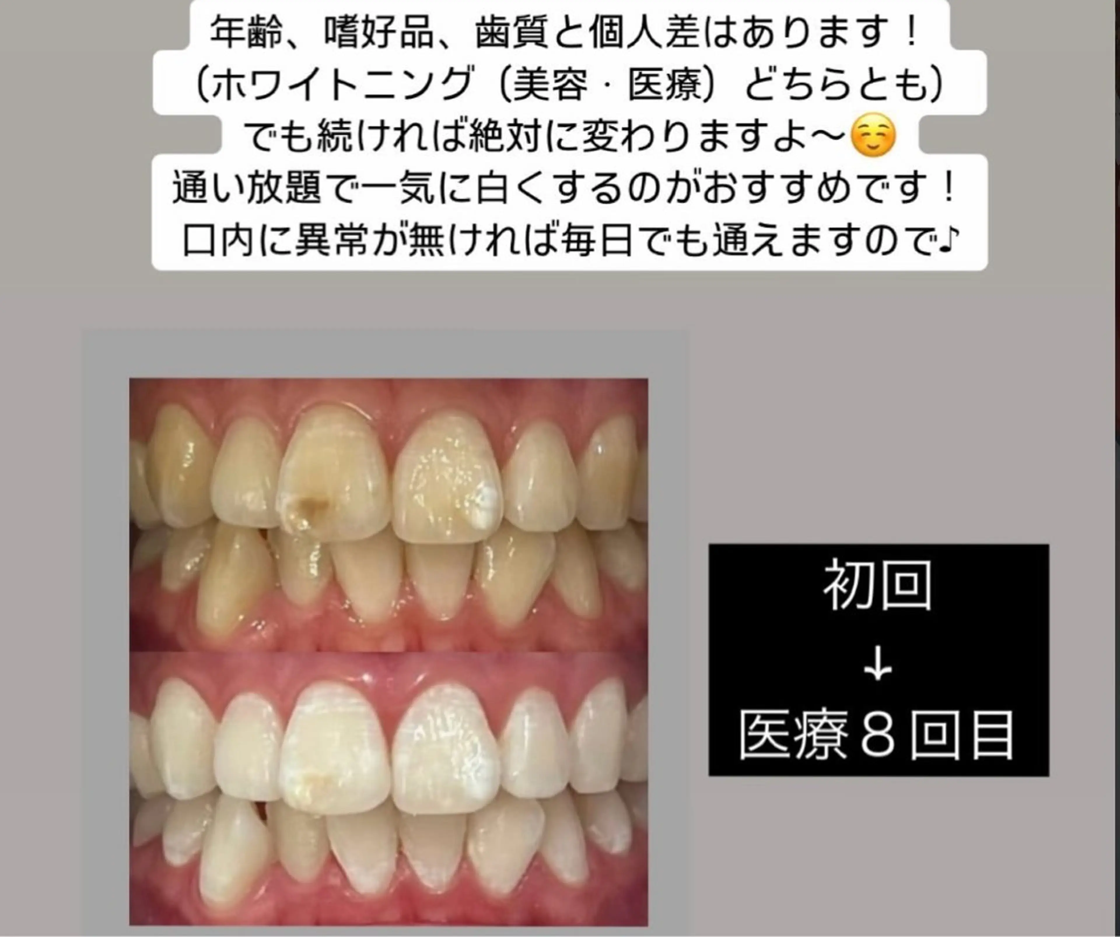 Kaula所属・Kaula セルフホワイトニングのその他イメージ