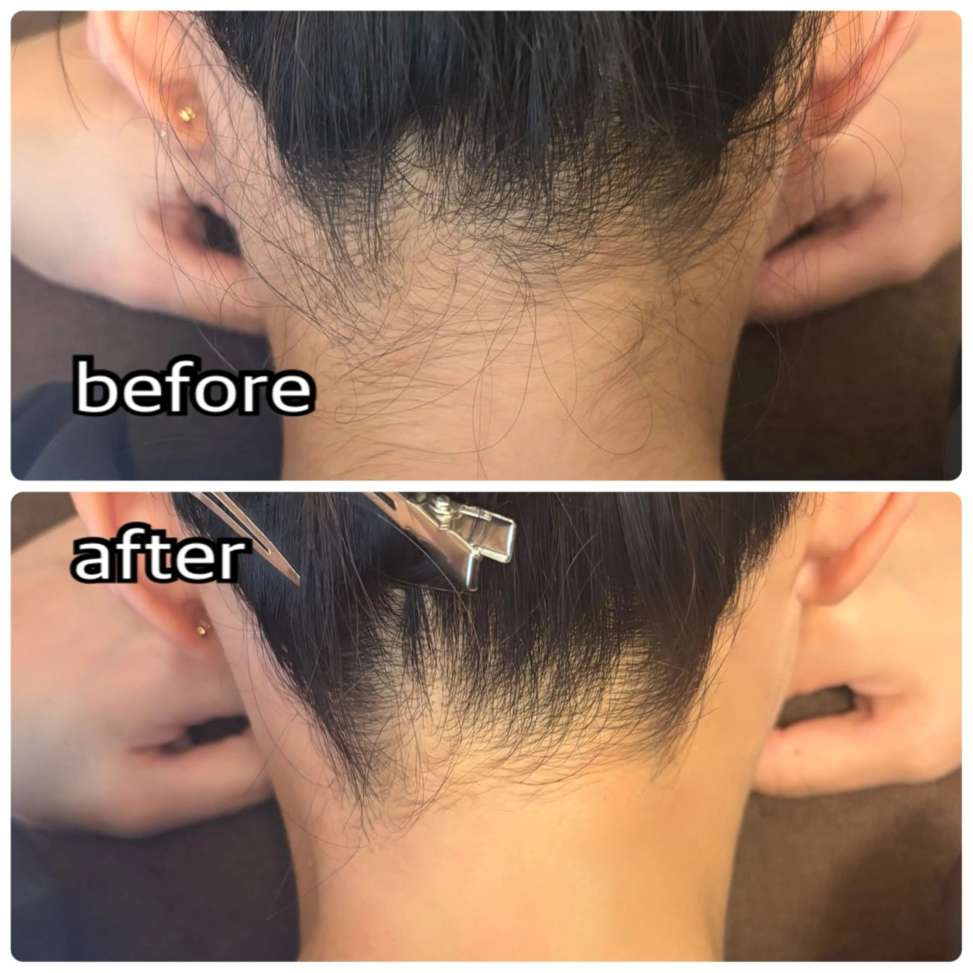 【先着10名】うなじWax脱毛モニターの写真