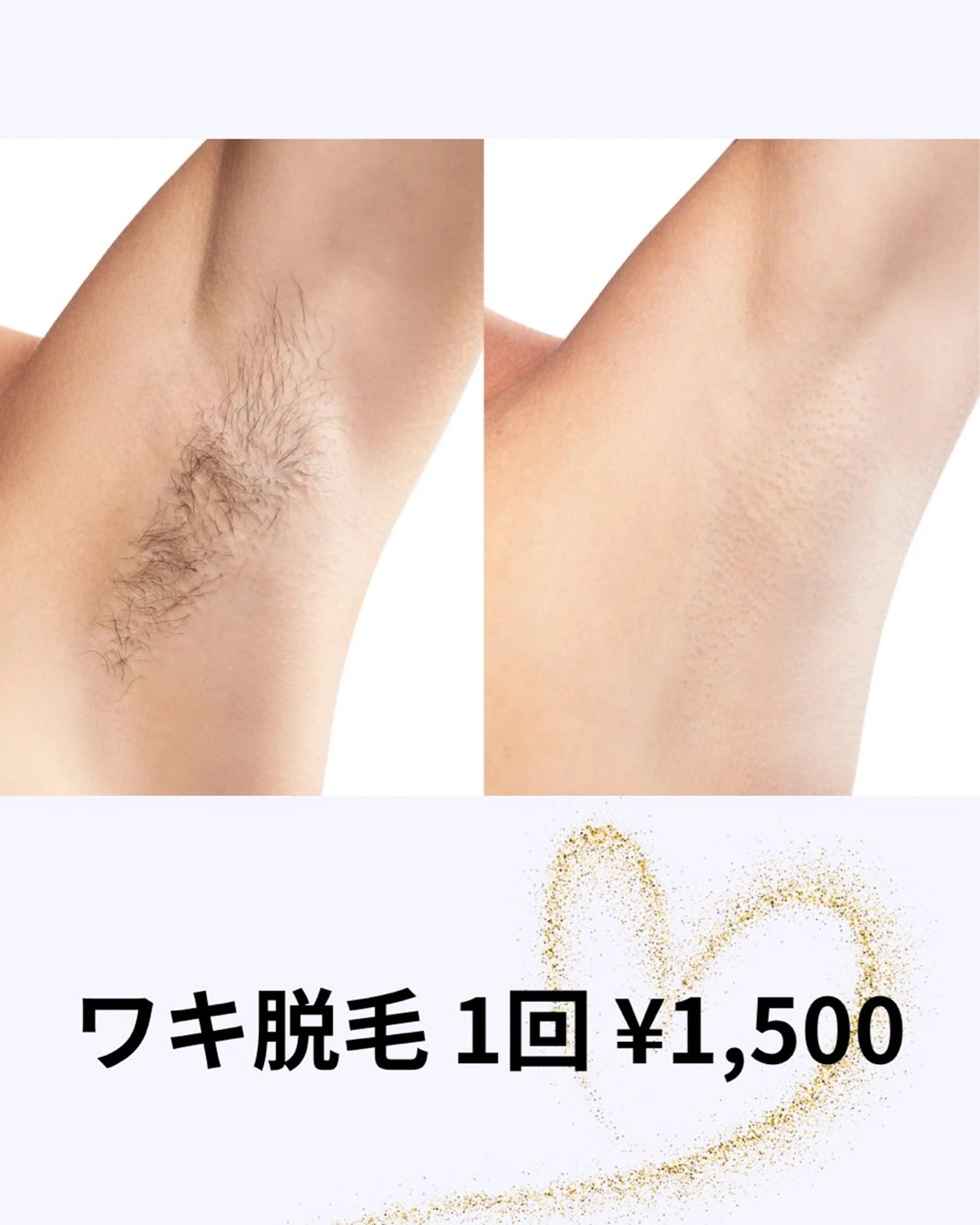 ワキ脱毛の写真
