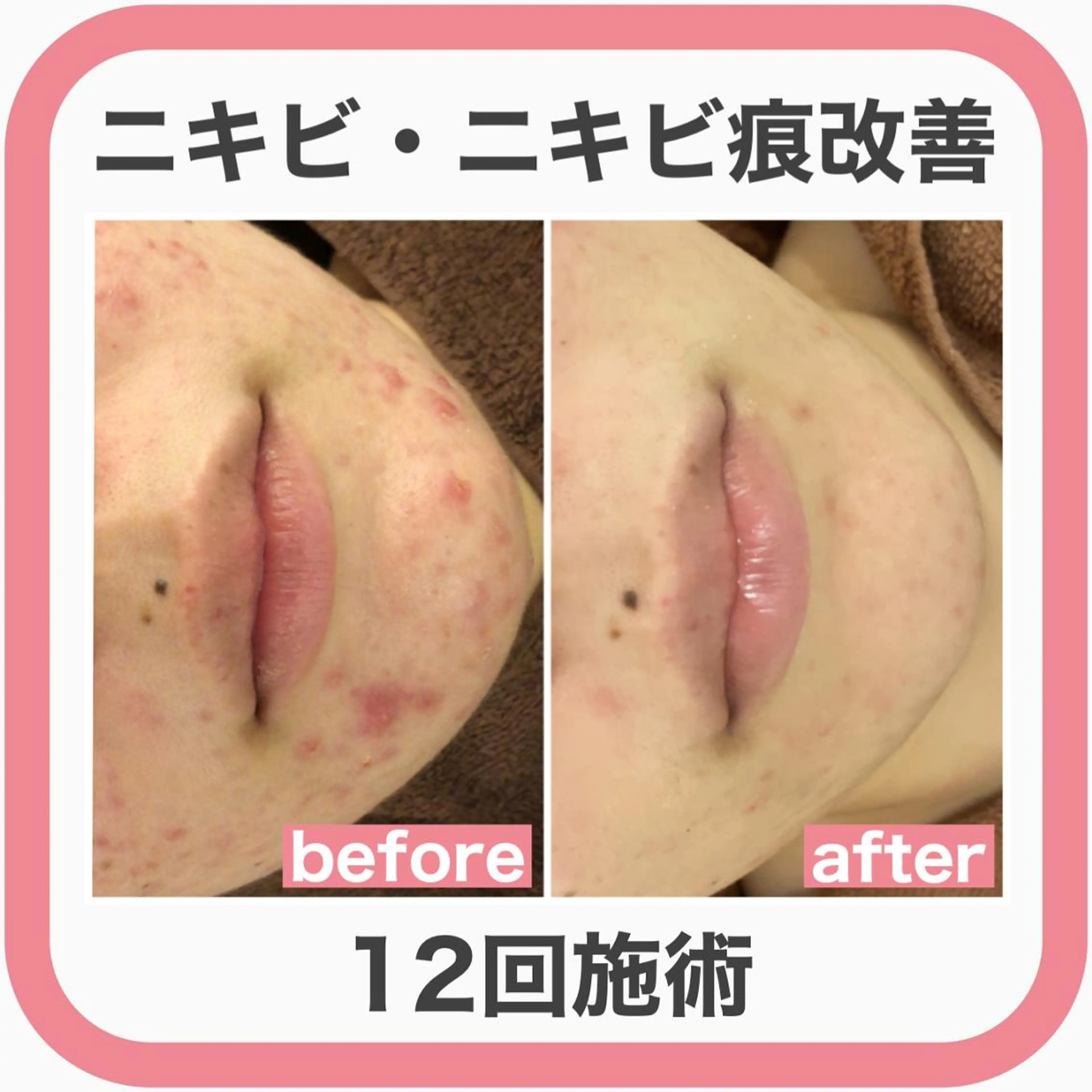 皮膚科より効果あり ⁉️最短ニキビ改善のエステ・リラクイメージ