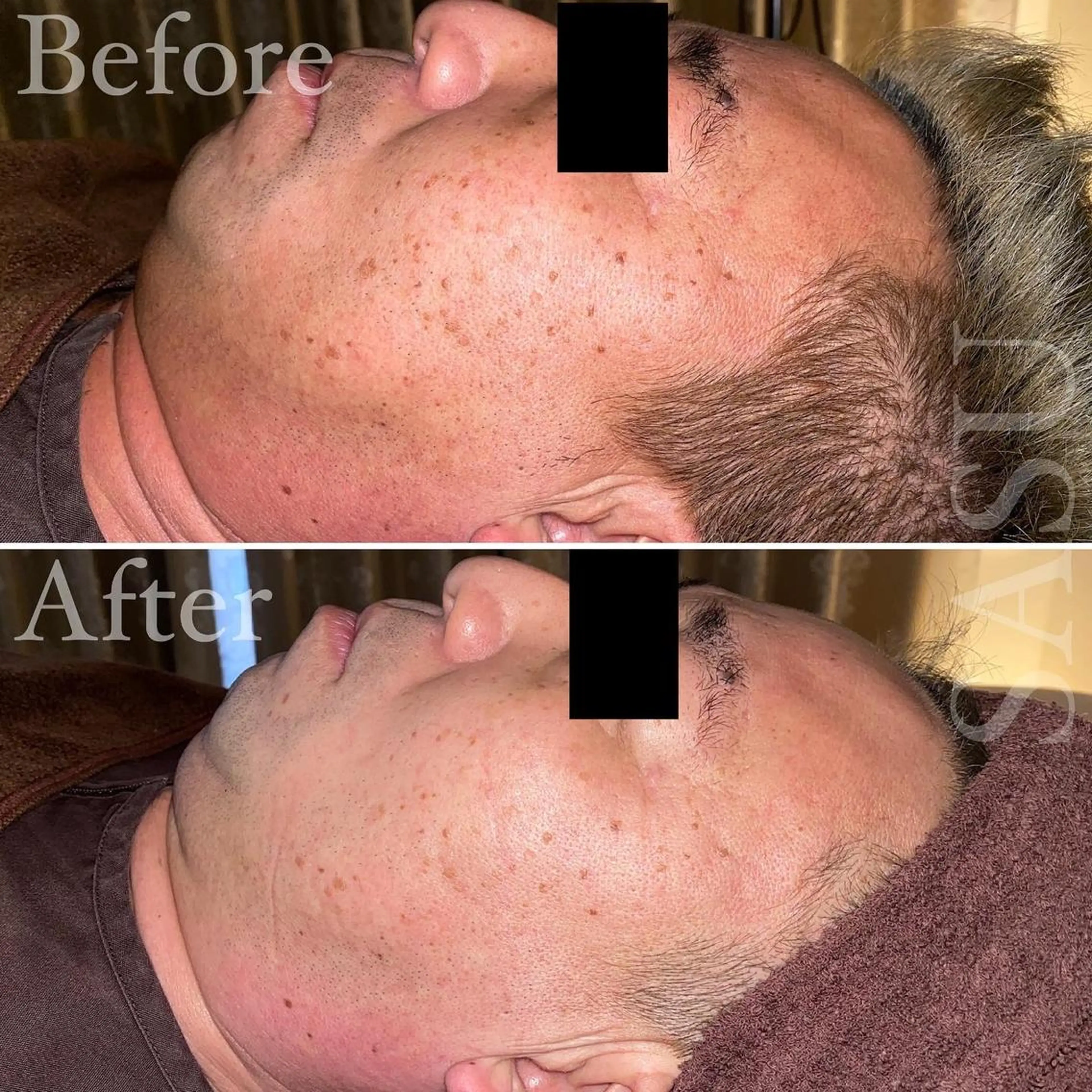 メンズ マツエク・マツパ アイブロウ 即小顔♥️美容鍼× ハーブピーリングのその他イメージ