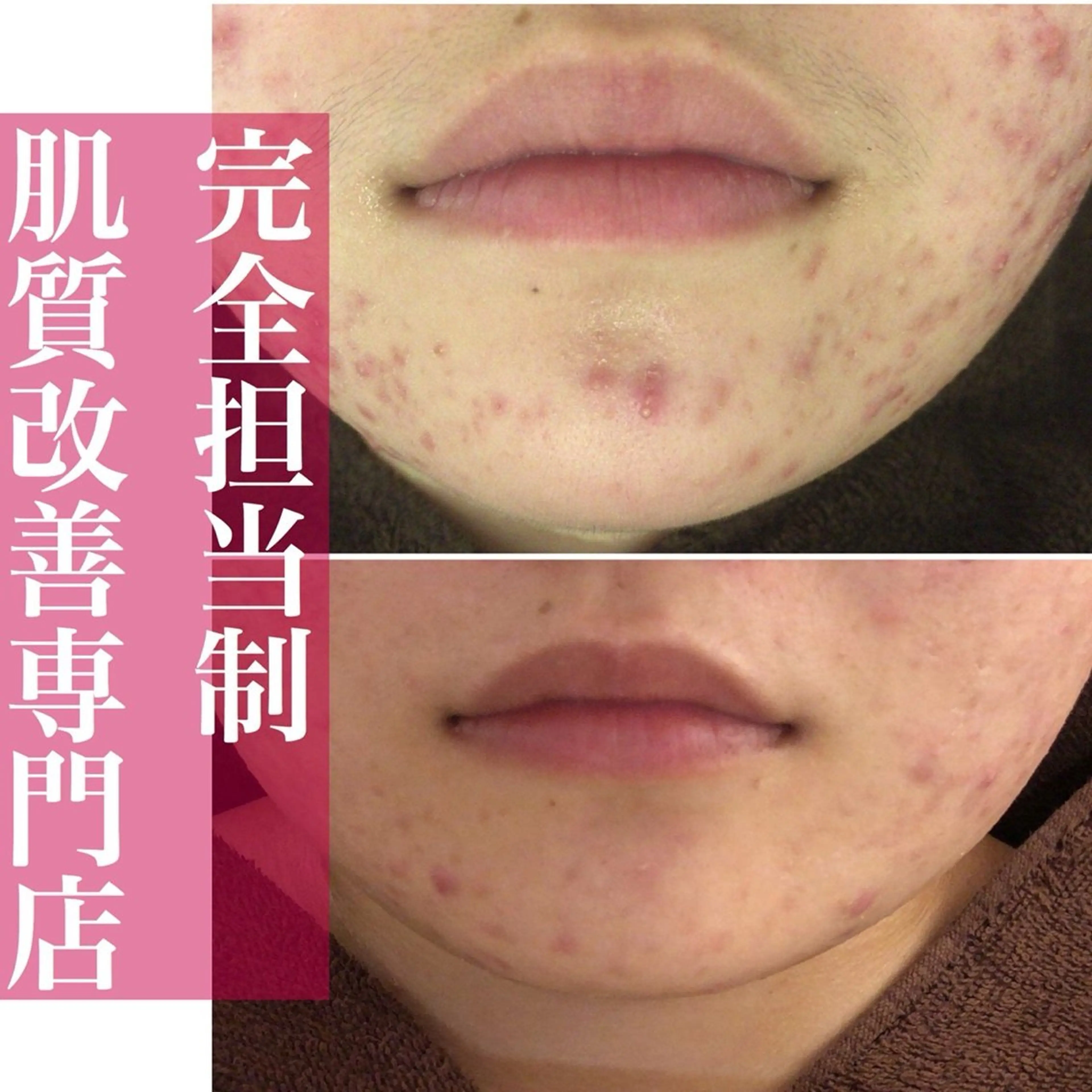 学生ニキビ改善🍀 優しい肌質改善のエステ・リラクイメージ