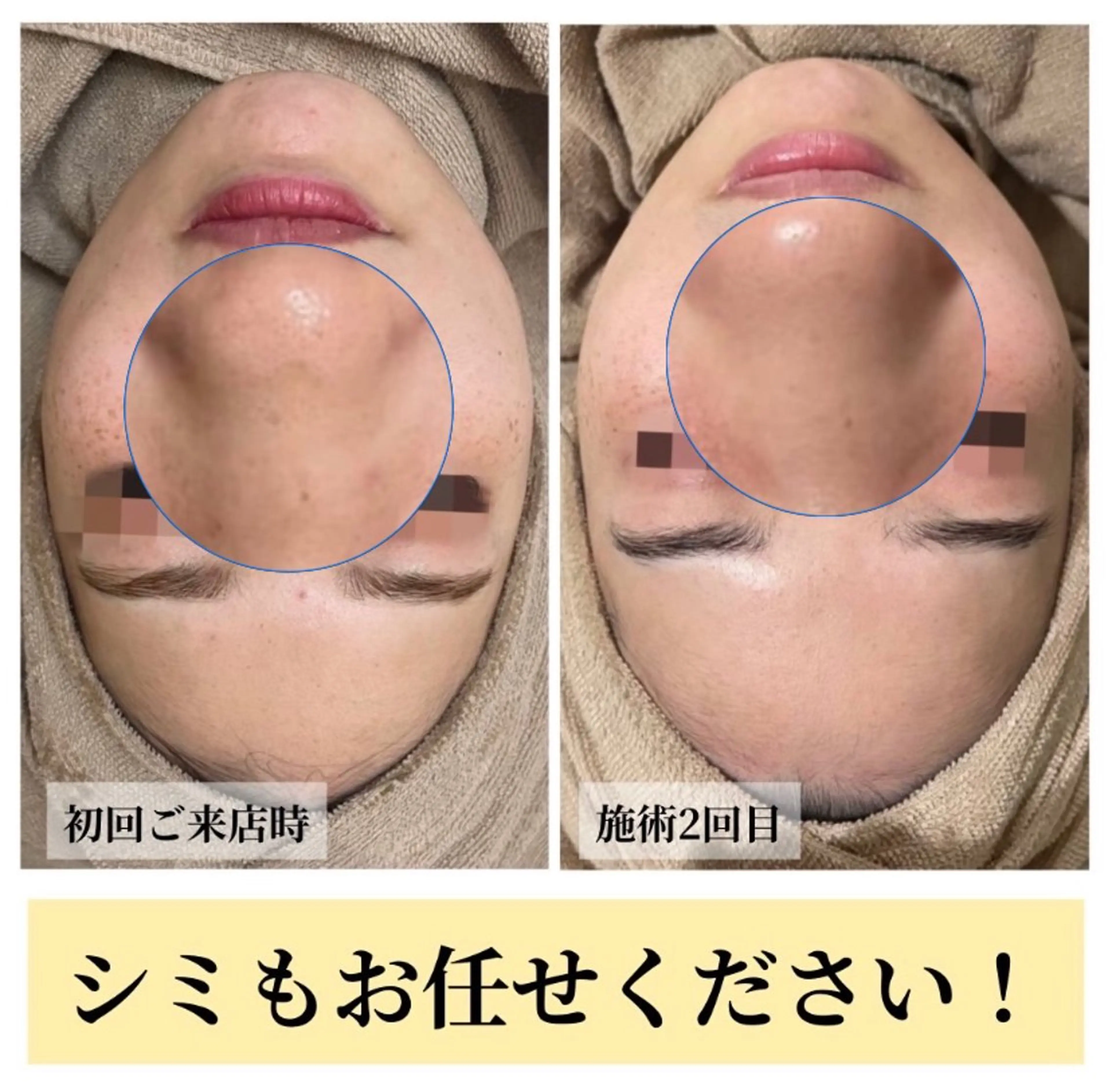 エステ ハーブピーリング・毛穴ケア専門サロンSalon de LENA所属・ハーブピーリング 毛穴専門店/栄のエステ・リラクイメージ