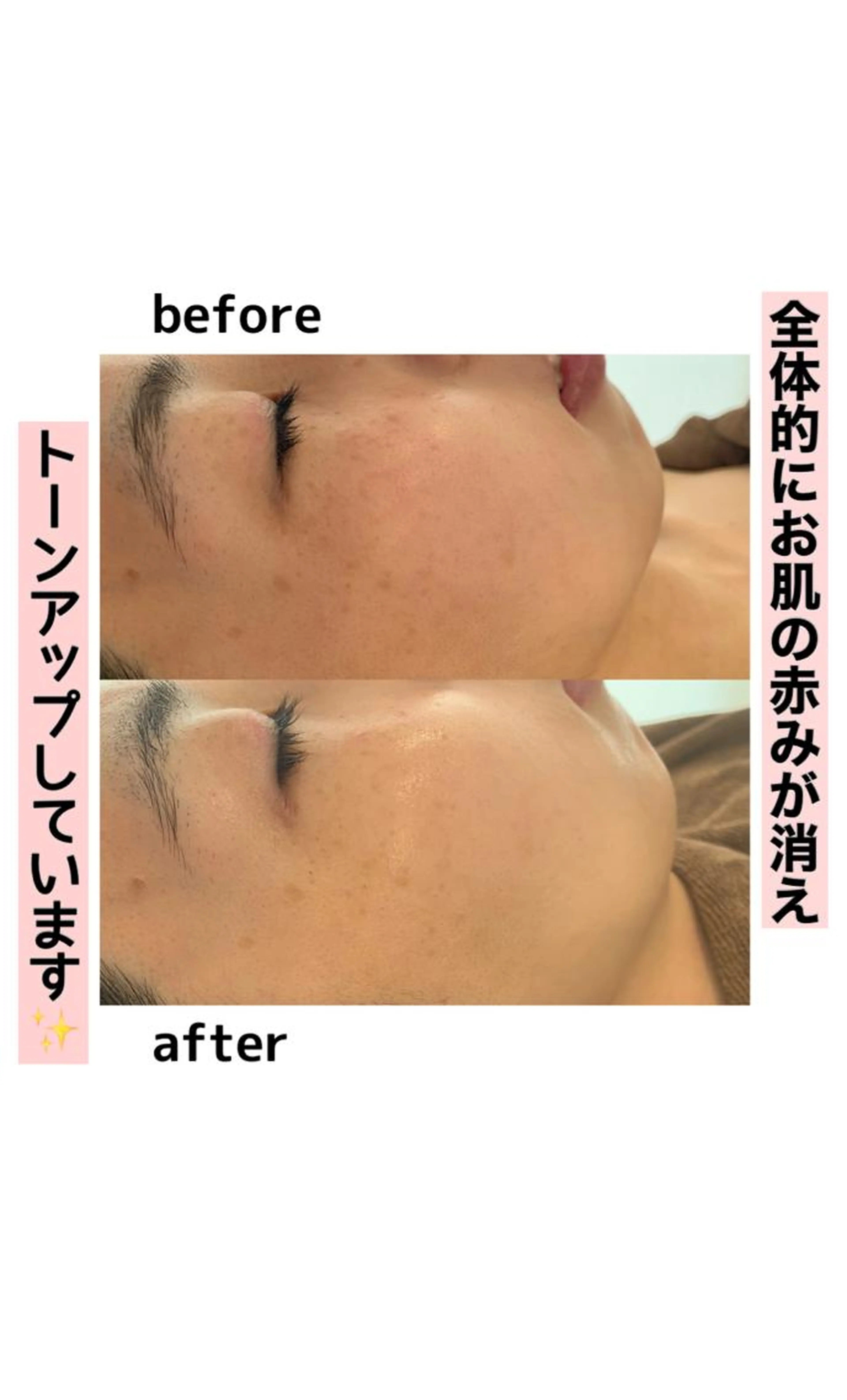 ニキビ・毛穴ケア♪嬉しい美肌パック付☆クレンジング・ウォッシング、美肌パック付き☆顔脱毛１回の写真