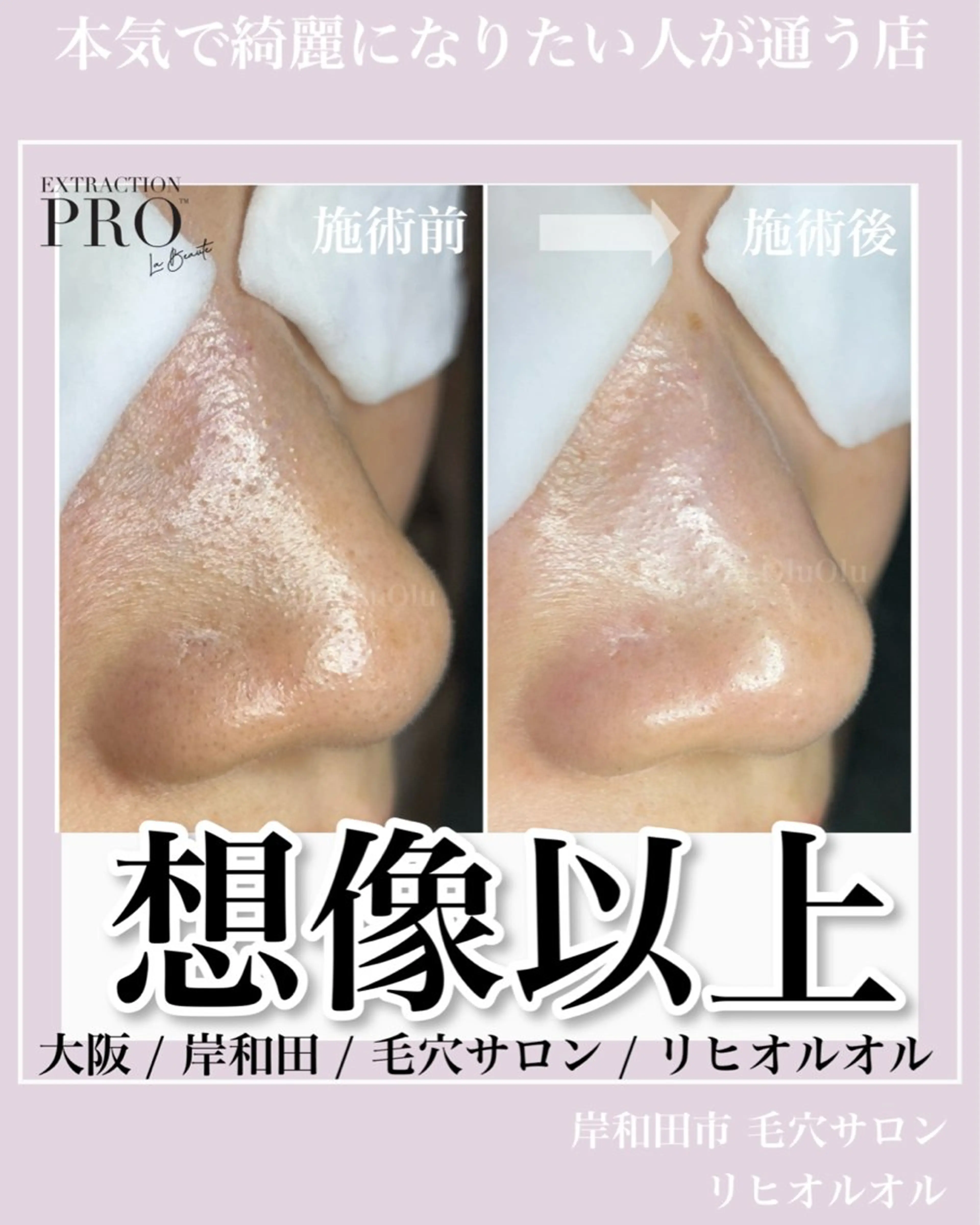 【新規】当店1番人気‼️《美肌デコルテコース＋肌リセットダブルケア🌿》毛穴洗浄とデコルテマッサージでお肌集中ケア✨️の写真