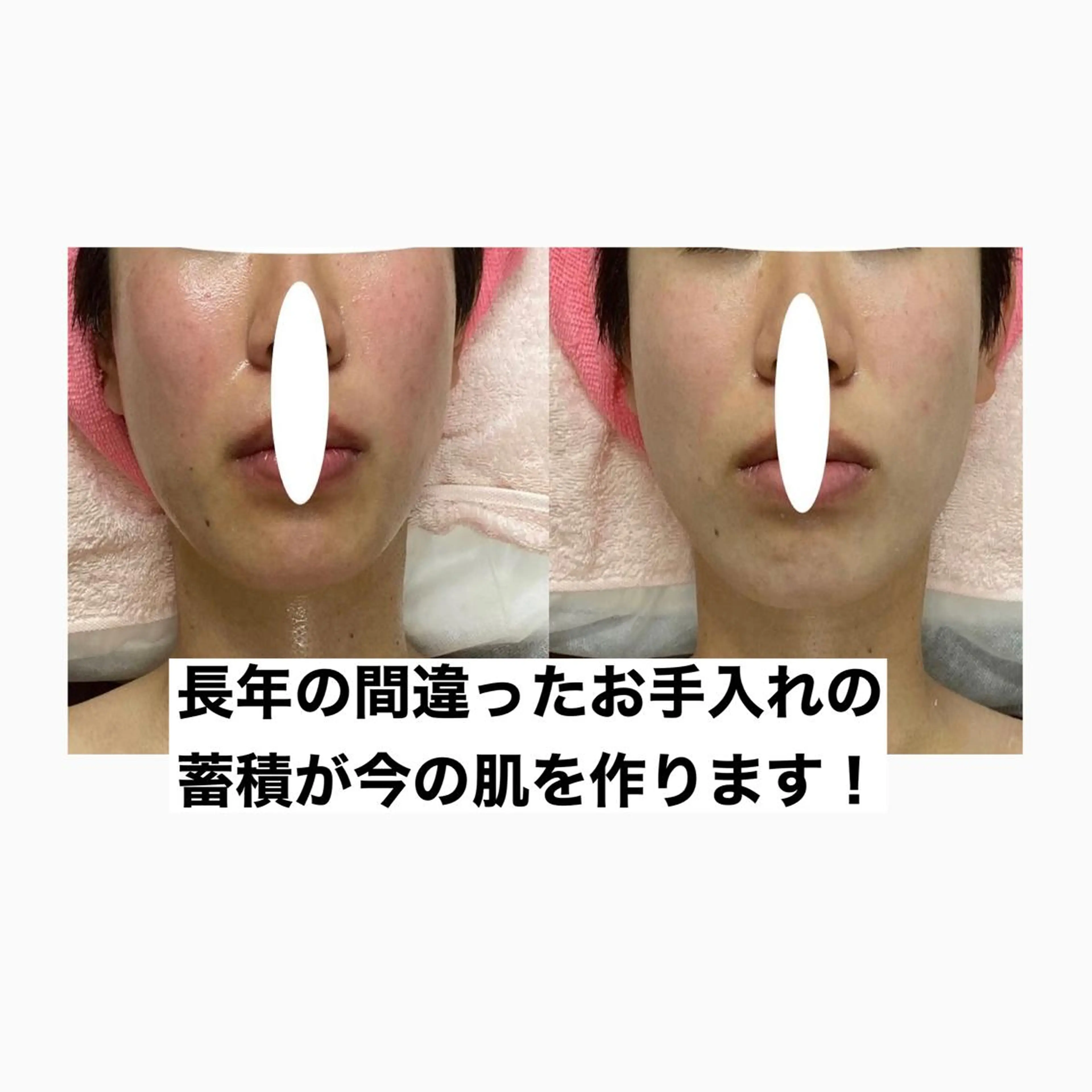 オアシス・さくら所属・中村貴子都度払い脱毛 小顔コルギのエステ・リラクイメージ