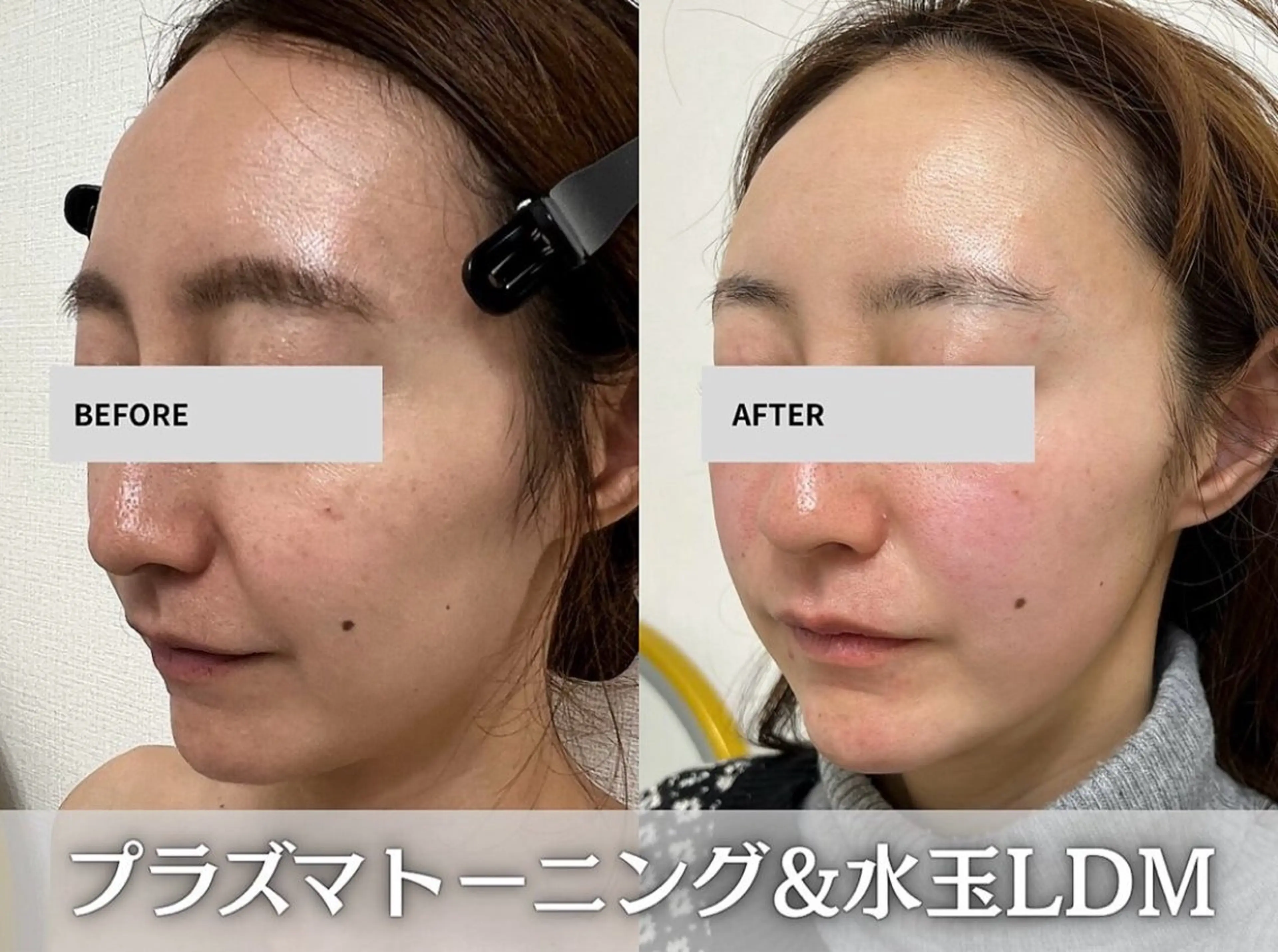 プラズマ×水玉LDM 2点！【たるみ・毛穴・ほうれい線】の写真