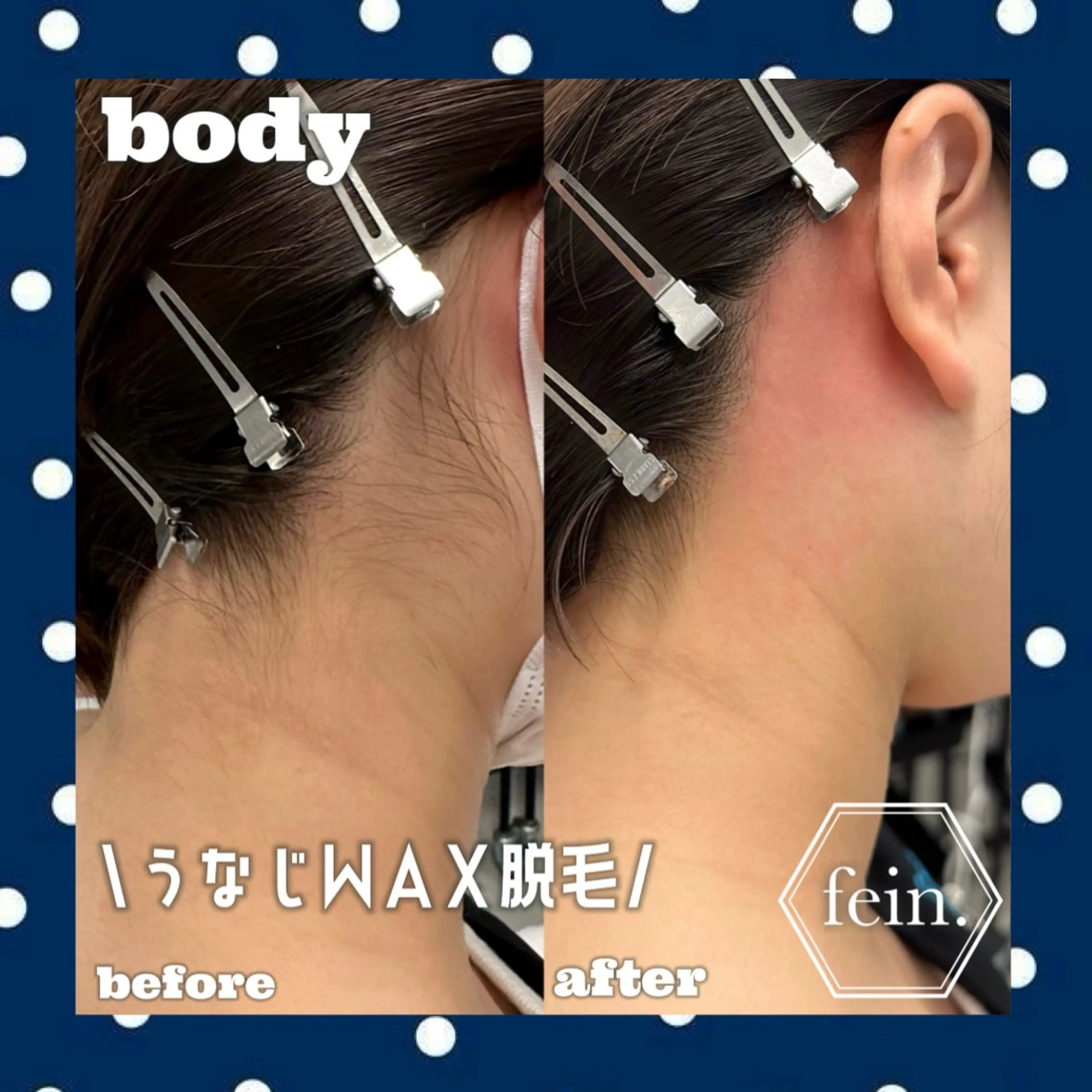 【うなじワックス脱毛】🤍ྀི角質も一緒にケアしてツルスベ肌に✨トーンアップ効果🫧の写真
