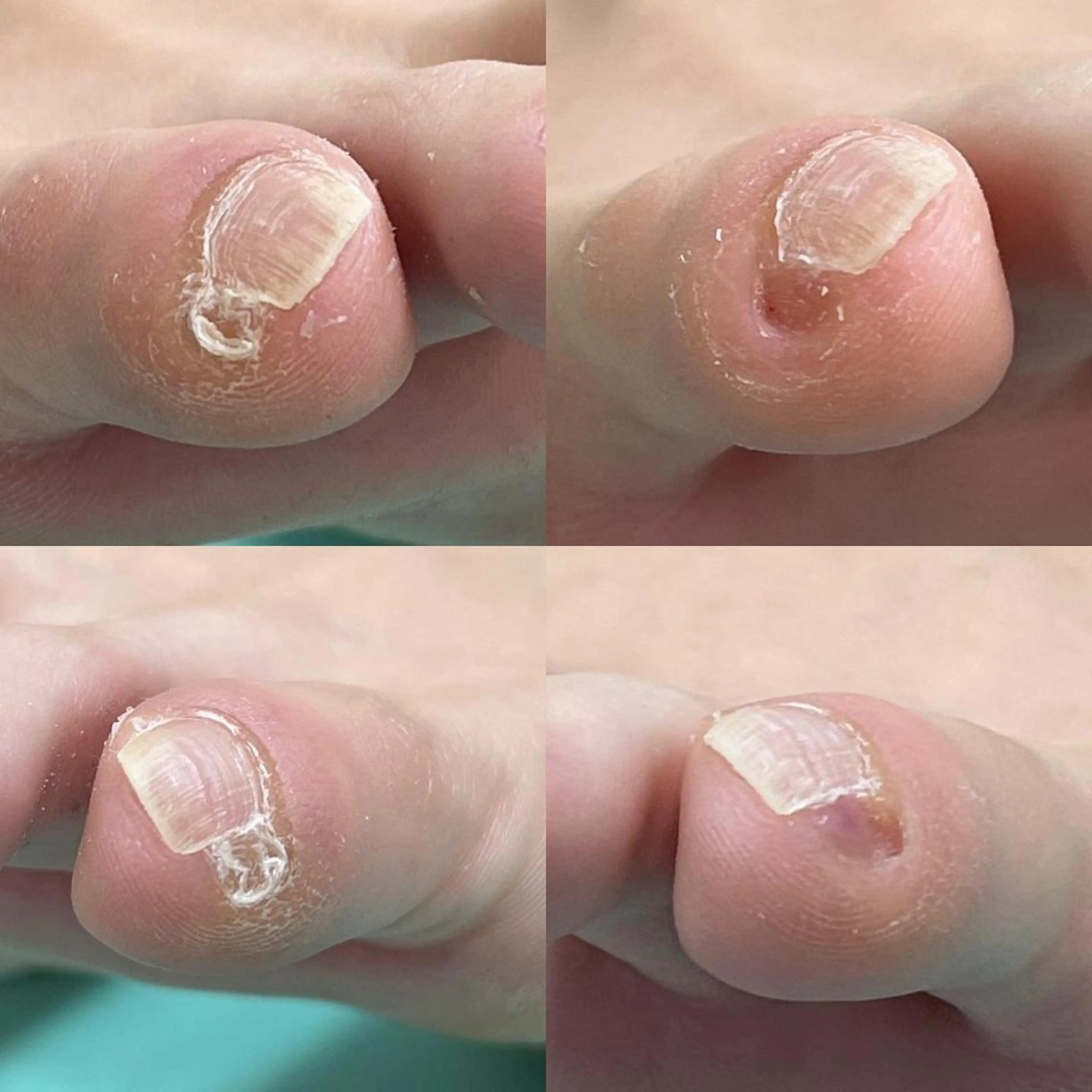 ️ 【副爪ケア】小指の爪横の角質の塊を綺麗にします⭐️キレイに除去して痛みや違和感もスッキリ🌈の写真