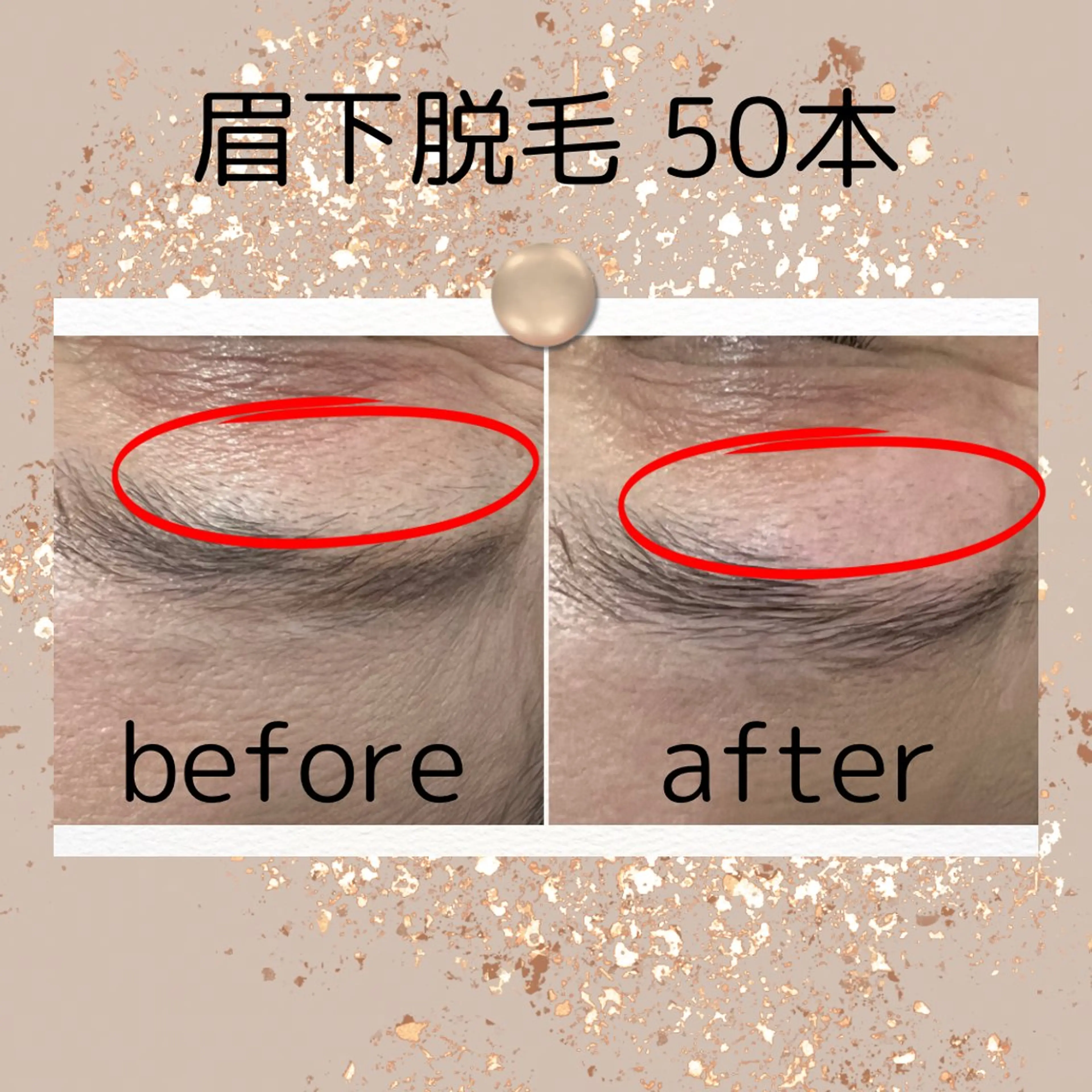 脱毛 中庄駅前エステ BRILLAR小豆のヘアスタイル