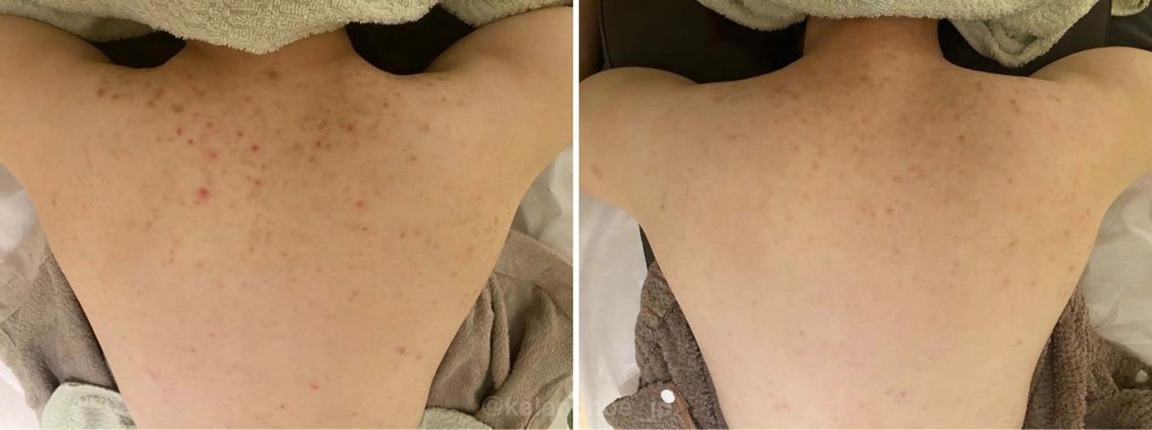 肌質改善 KALANCHOEのエステ・リラクイメージ