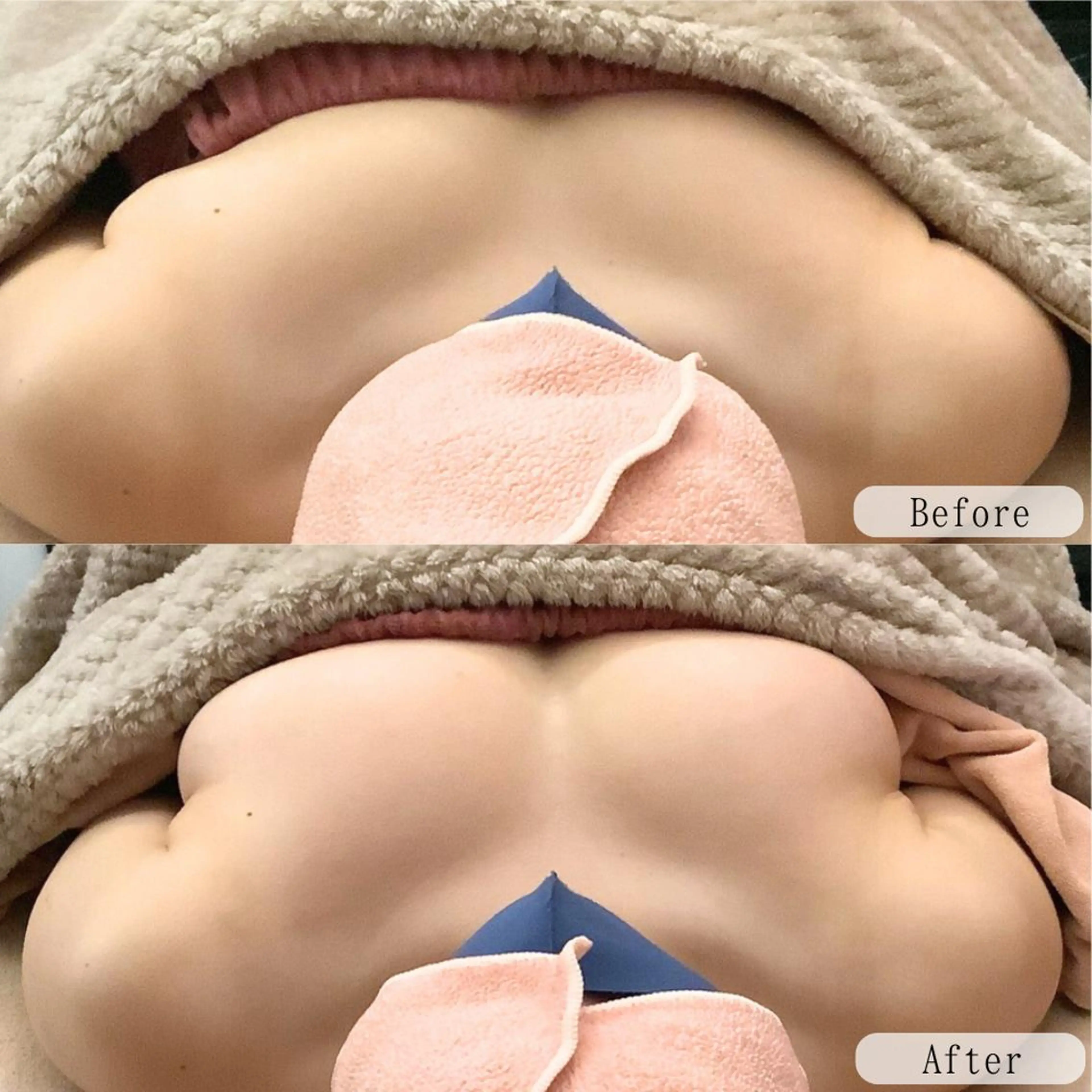 【上半身集中】バストアップ&超小顔ケア ¥30,000→¥11,600の写真