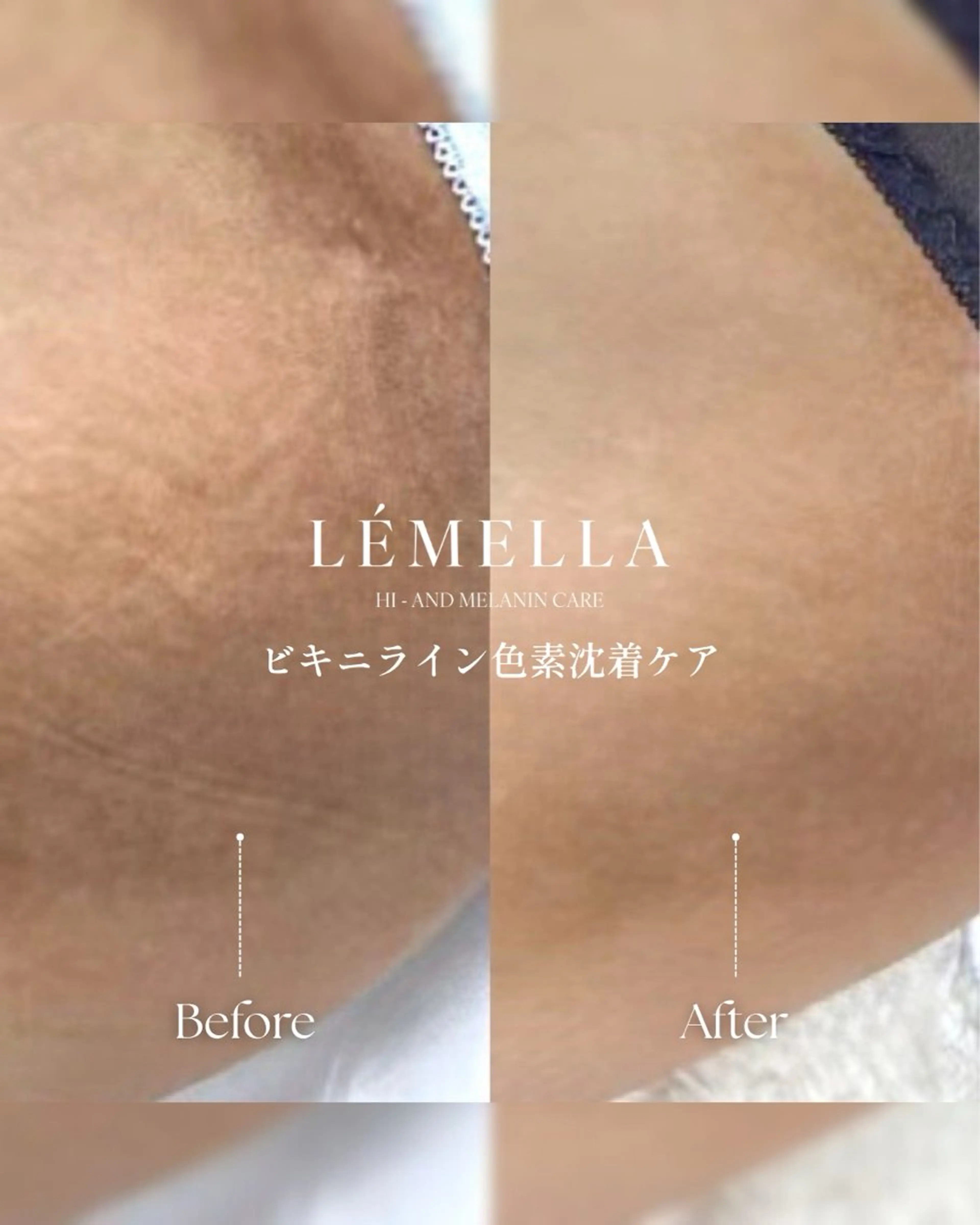 📍【またぐら】足の付け根   🌟ショーツラインの黒ずみに🌟ルメラ/メラニンケアの写真