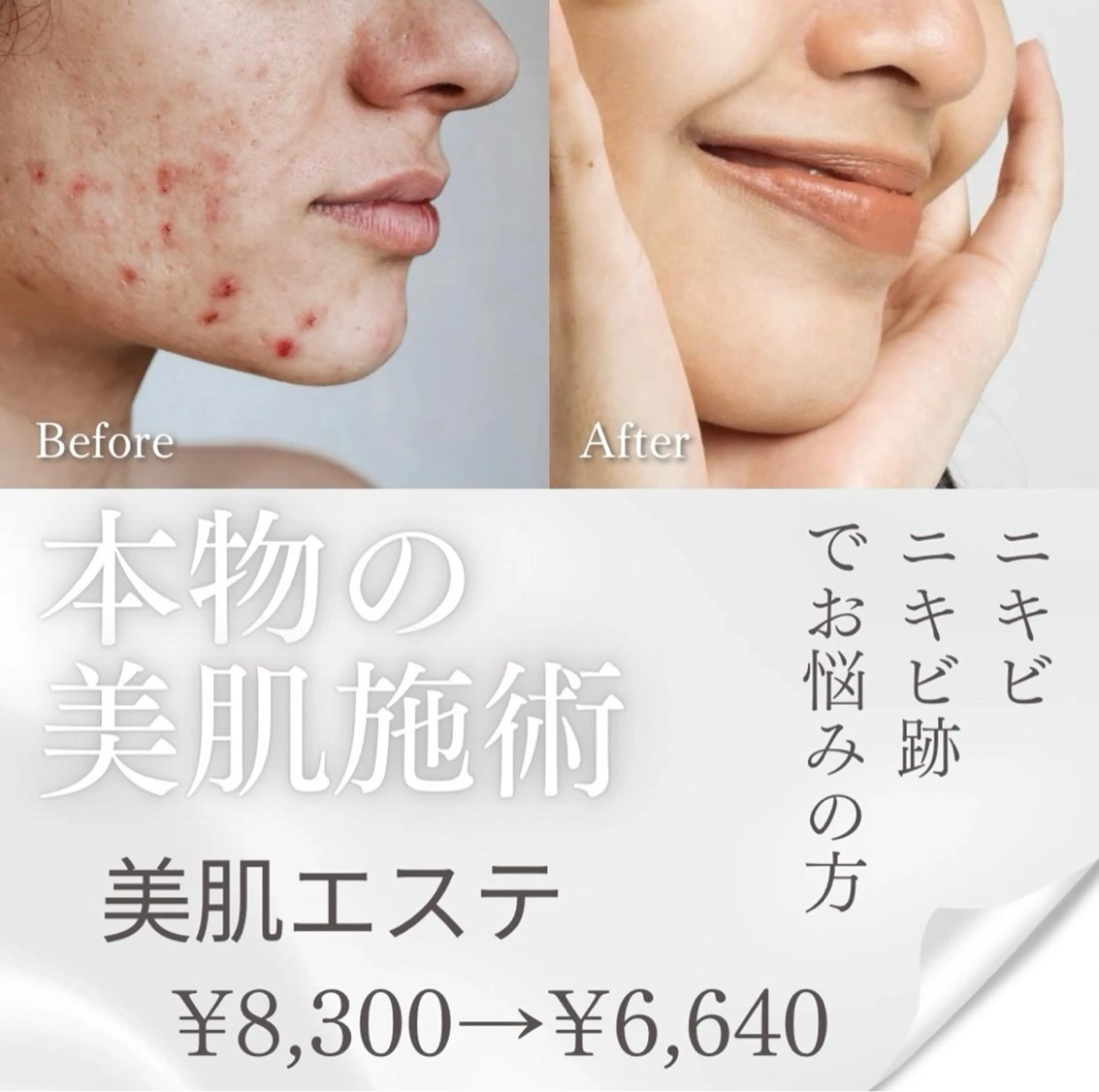 〖肌質改善〗ニキビ・ニキビ跡解消エステの写真
