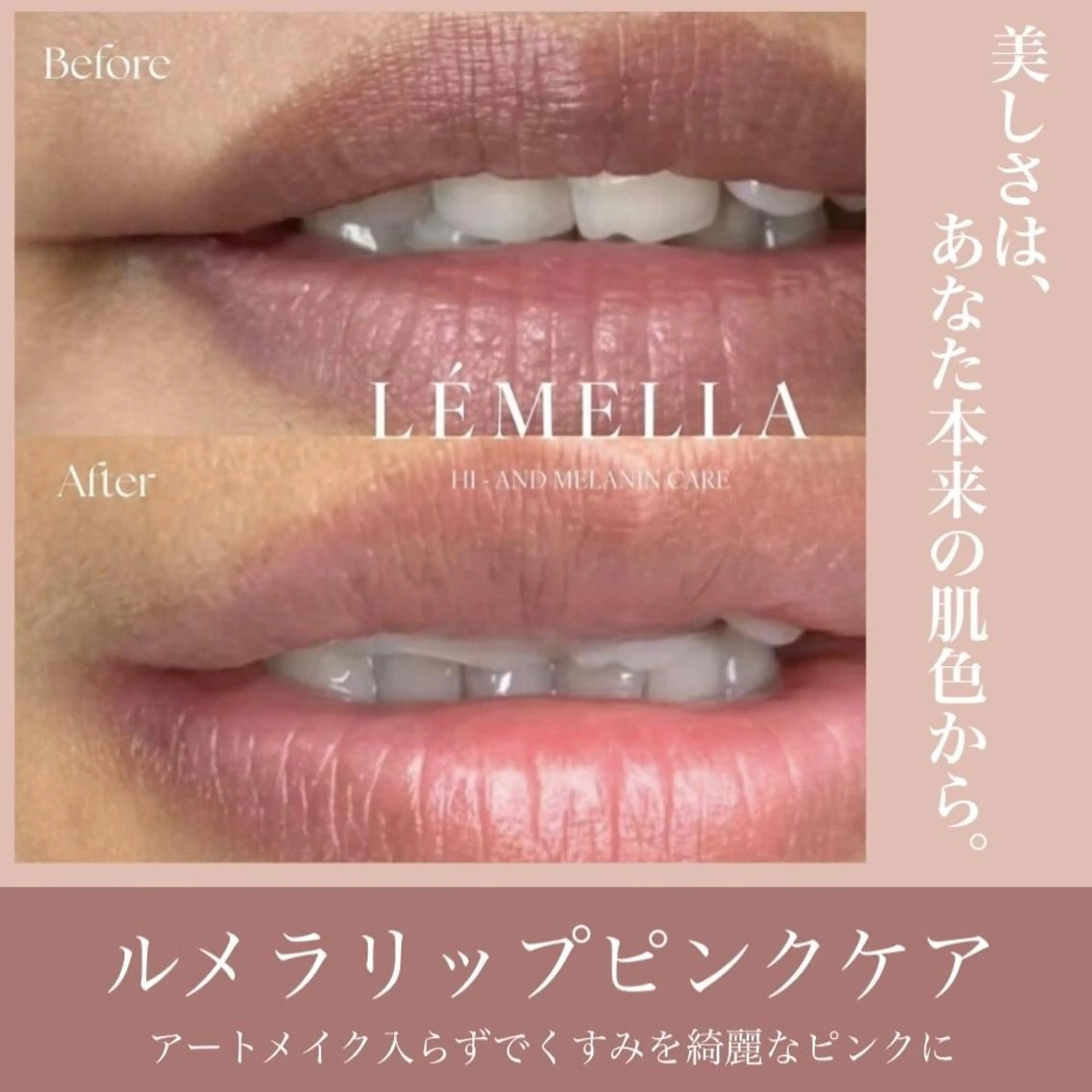 韓国シェアNo.1【ルメラ×唇💋】黒ずみ/メラニンケア¥65000→¥32900の写真