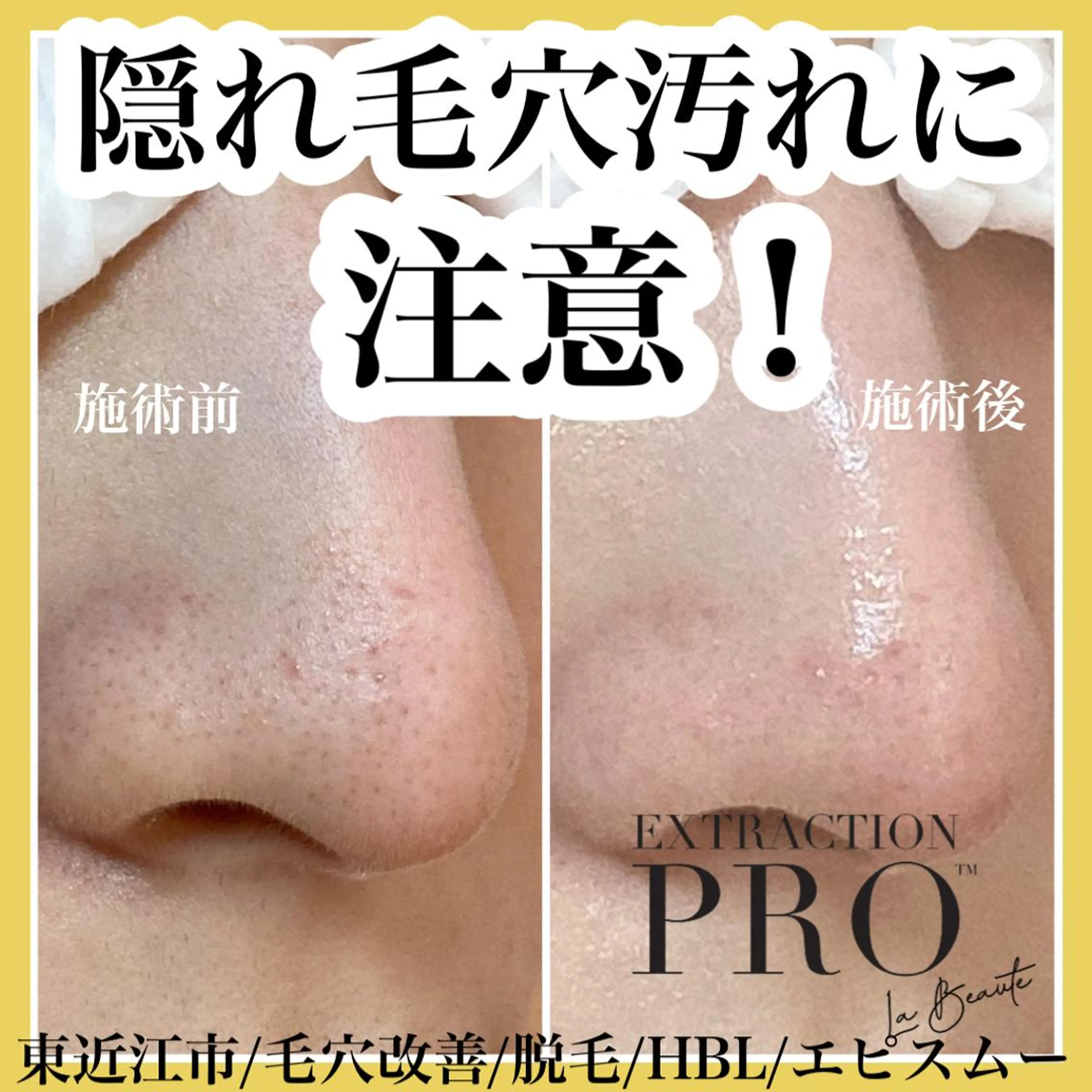 epismoo 脱毛/HBL/毛穴の眉毛・アイブロウイメージ