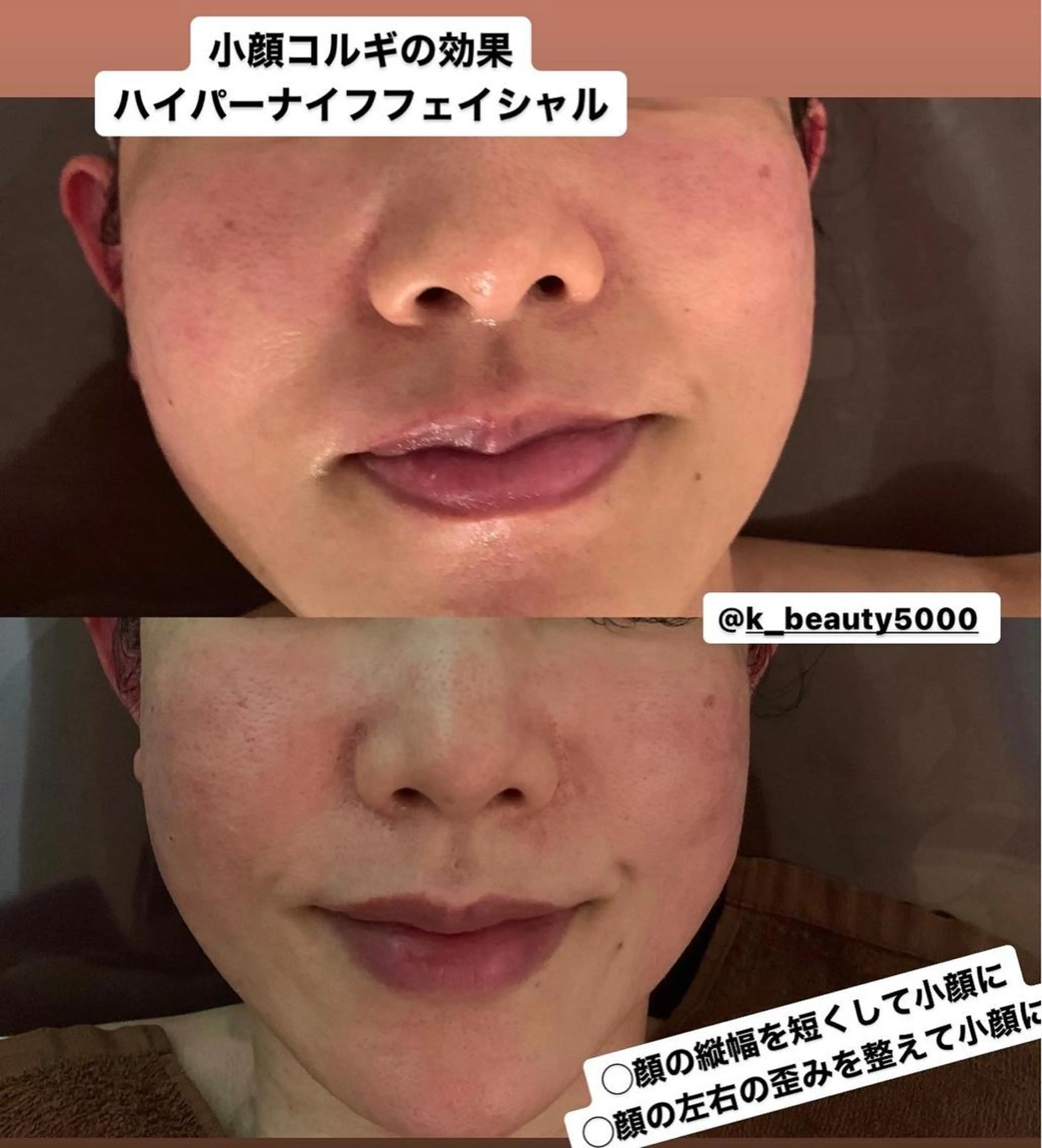 【ハイパーナイフ痩身&小顔コルギ&ハーブピーリング】K-Beauty　東新宿所属・kーbeauty小顔 コルギ&インディバのエステ・リラクイメージ