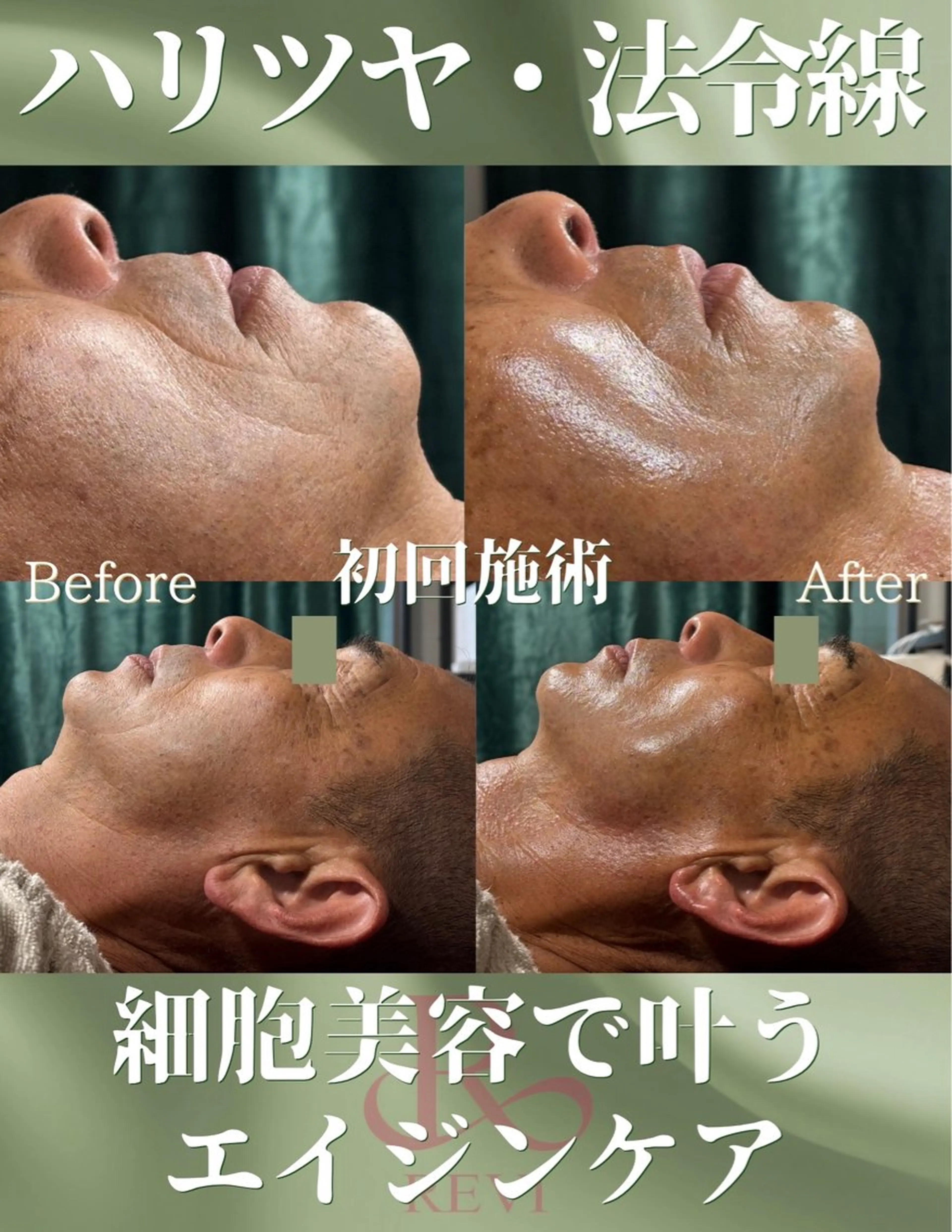 【シミシワ悩み】REVI陶肌トリートメント2g（剥けないハーブピーリング）+お任せオプションの写真