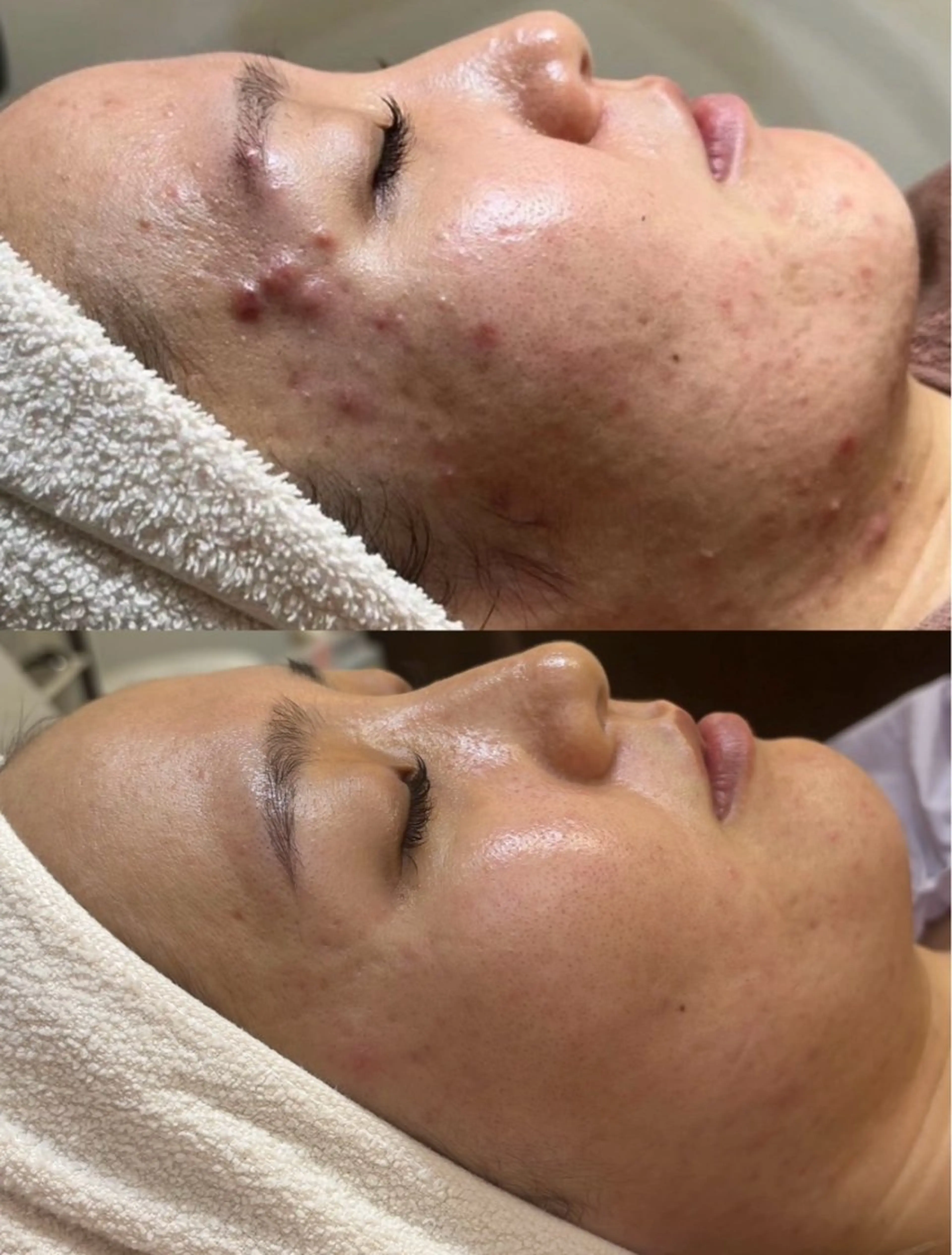 ♪2回目以降♪ハーブピーリング(男性・女性)の写真