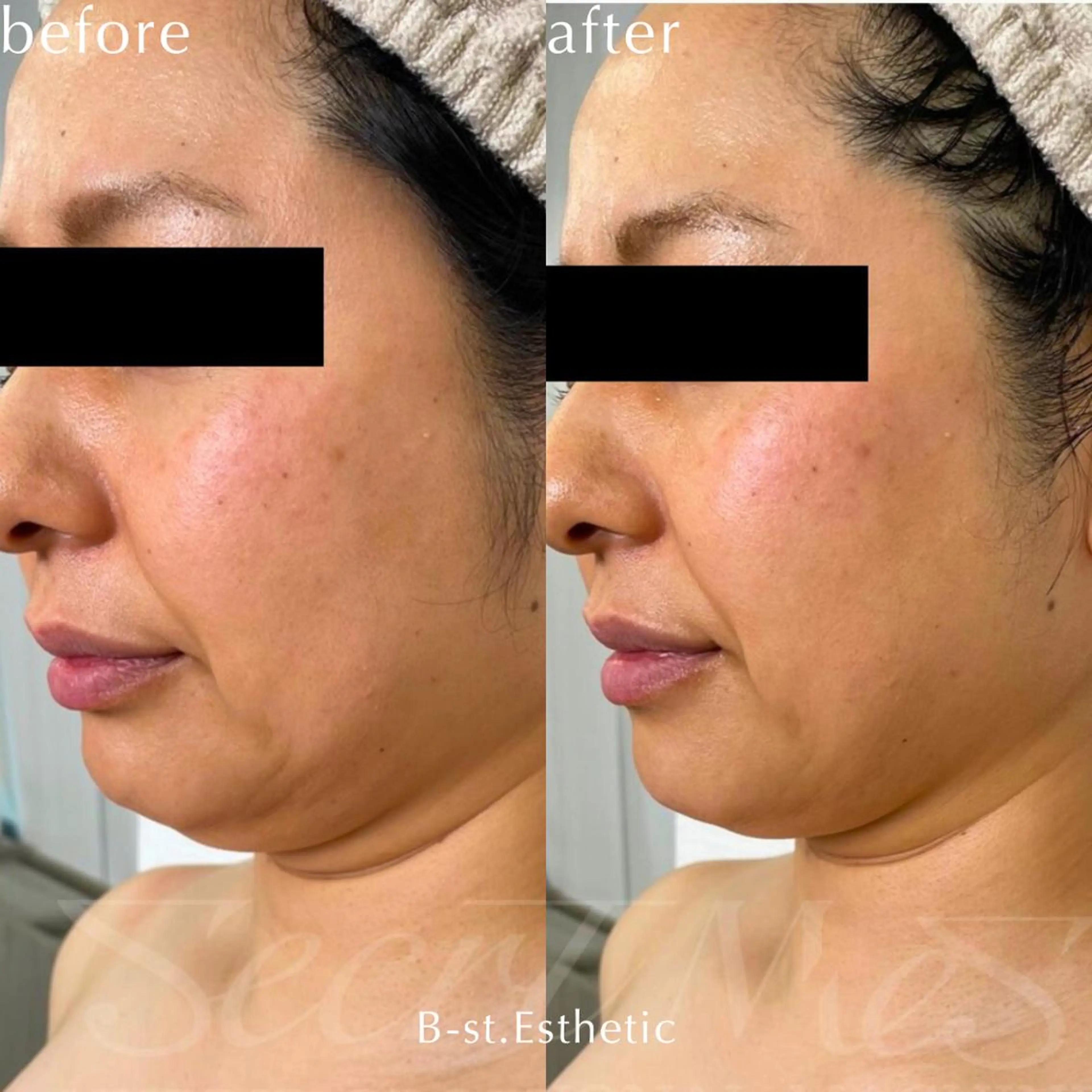 【頭皮】セルフスカルプケア30分間💆🏼‍♀️突起型ヘッドで頭皮に刺激⚡首肩コリ・眼精疲労の回復に効果的⭕️の写真