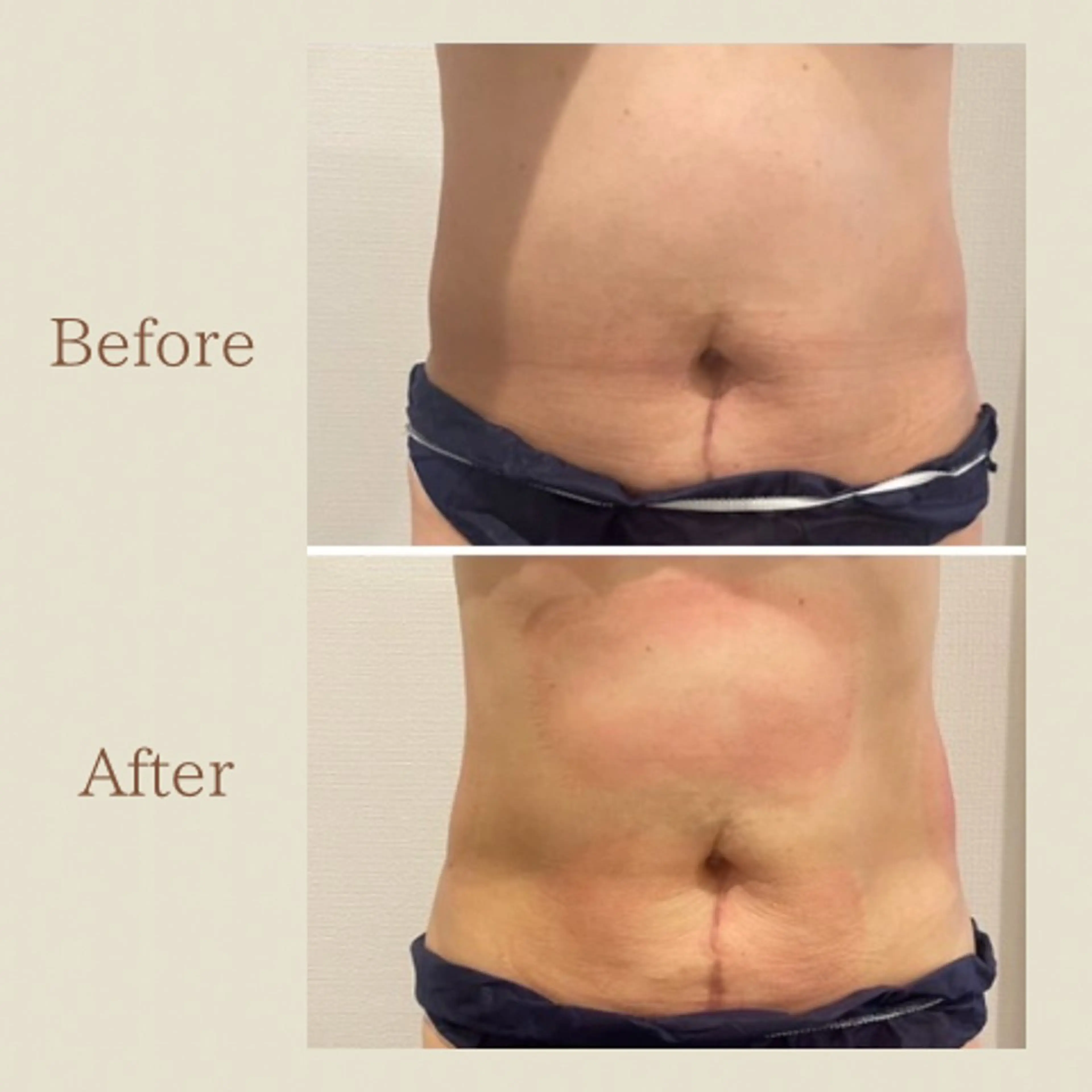 お腹痩せエステ Flat BELLY 恵比寿所属・【腸もみ/脂肪冷却】 お腹エステ/恵比寿のエステ・リラクイメージ