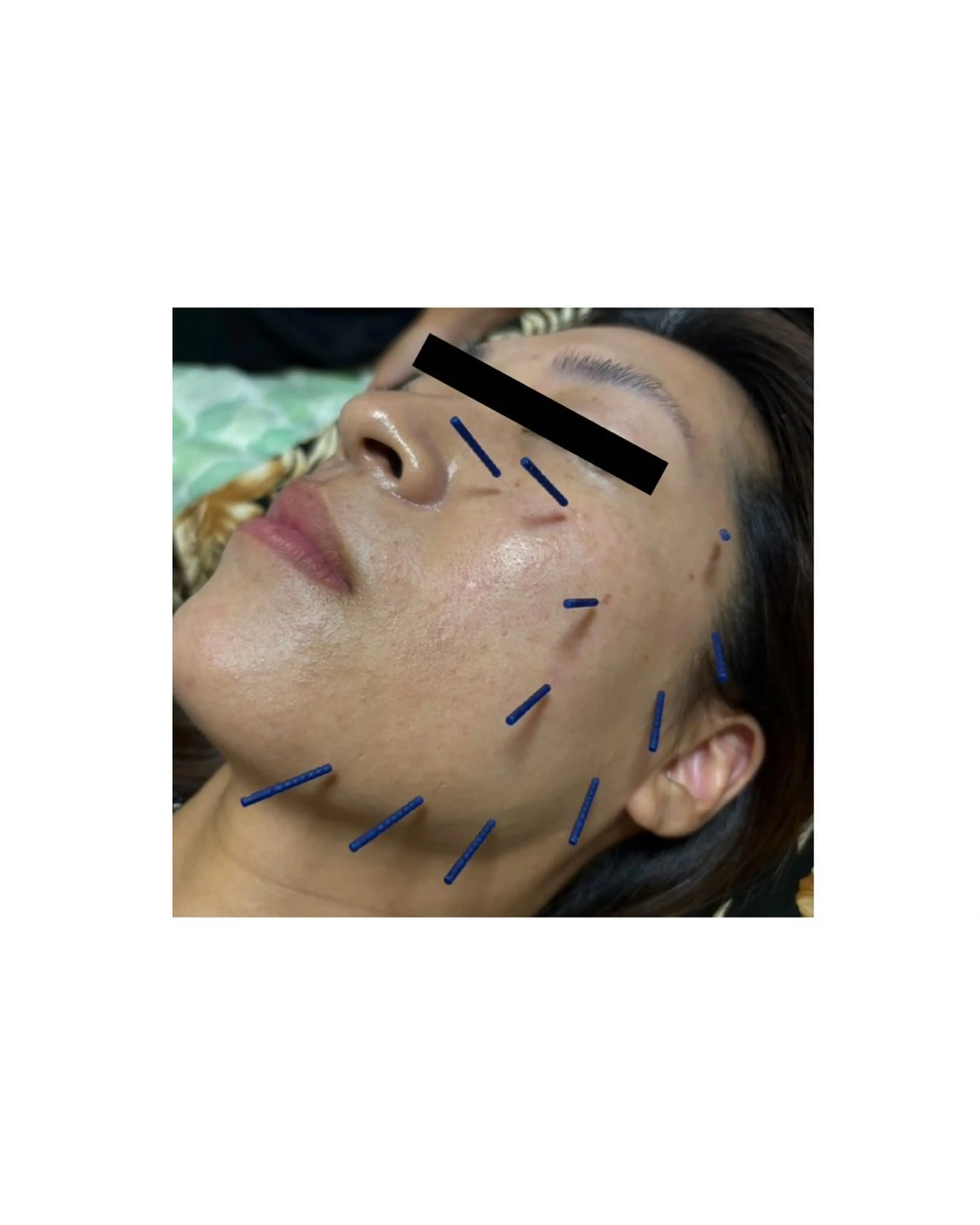 あおぞら整骨院所属・あおぞら 鍼灸整骨院のエステ・リラクイメージ