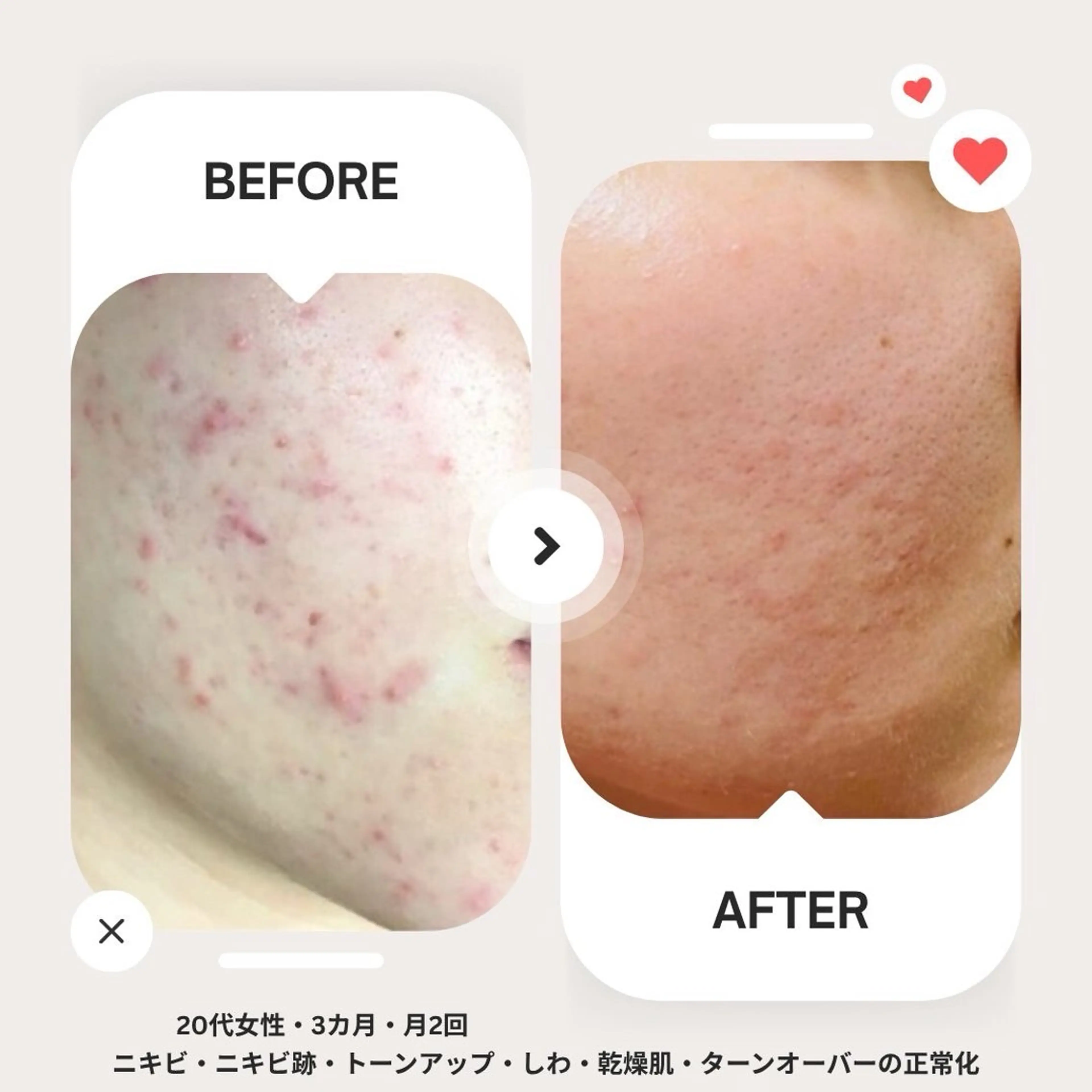 【ニキビ肌改善】プラズマの殺菌効果＋高濃度ヒト幹細胞美容液導入でニキビにさようなら！の写真