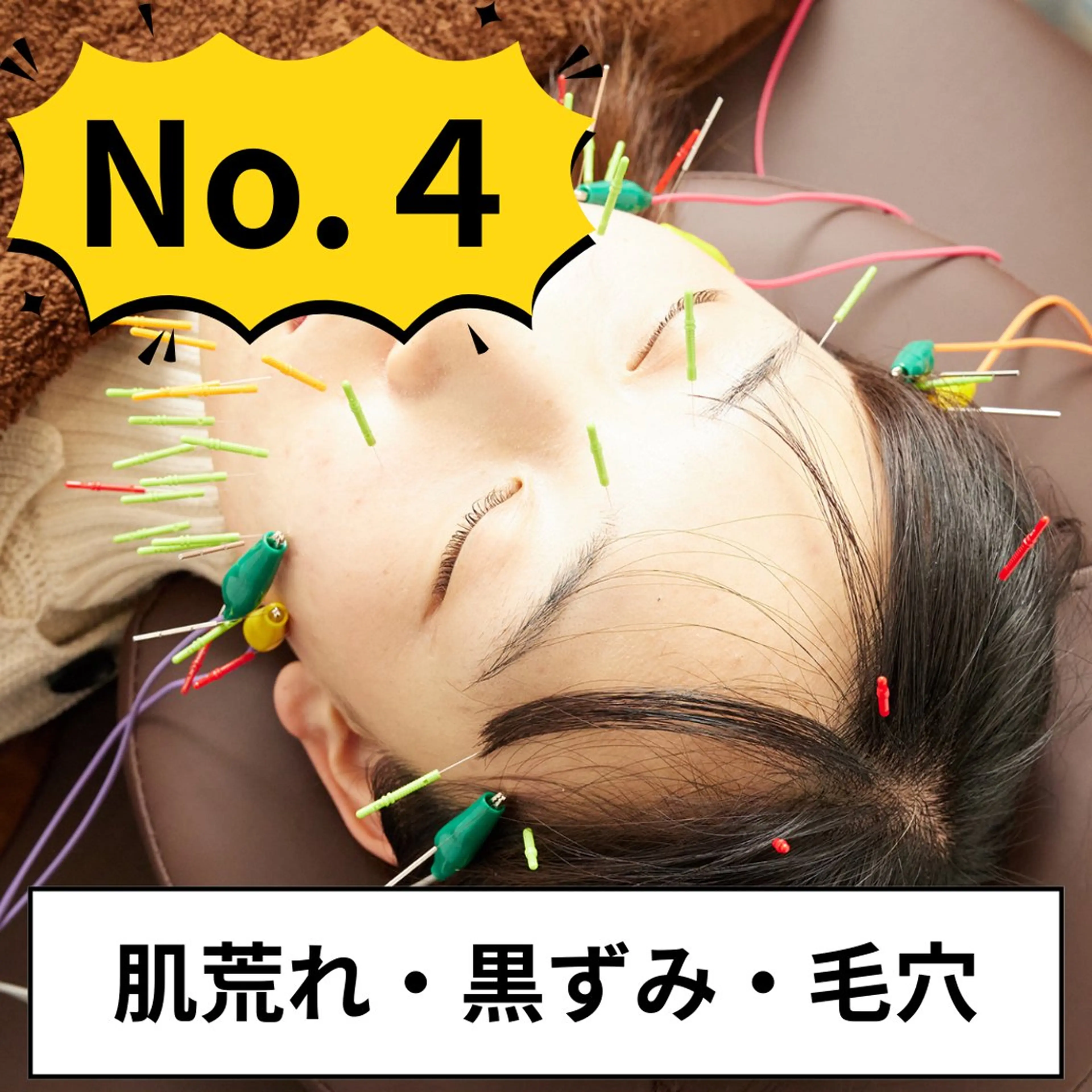【9月限定☆ツヤ肌】美容鍼+ハーブピーリング＋毛穴洗浄 ¥16,000→¥5,980の写真