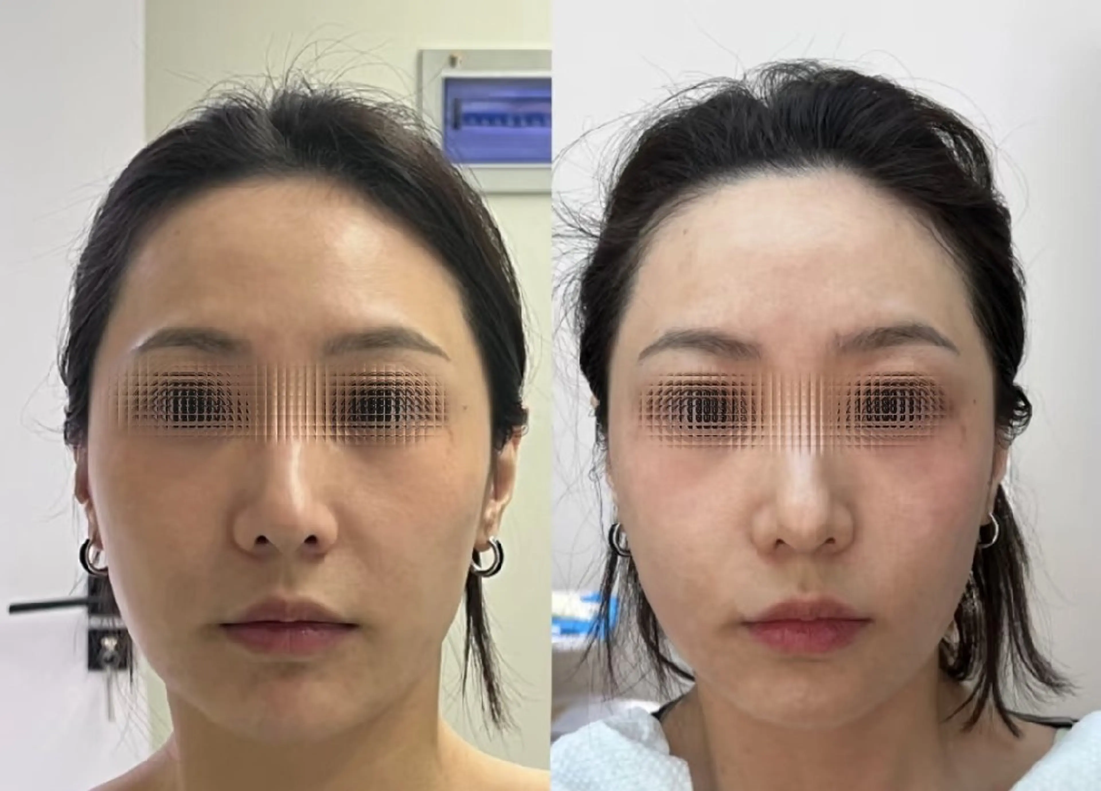 アイブロウ 眉毛ワックス脱毛 aliaハイフ&水光ジェットサロン所属・aliaハーブ水光店 エステティシャン募集のエステ・リラクイメージ