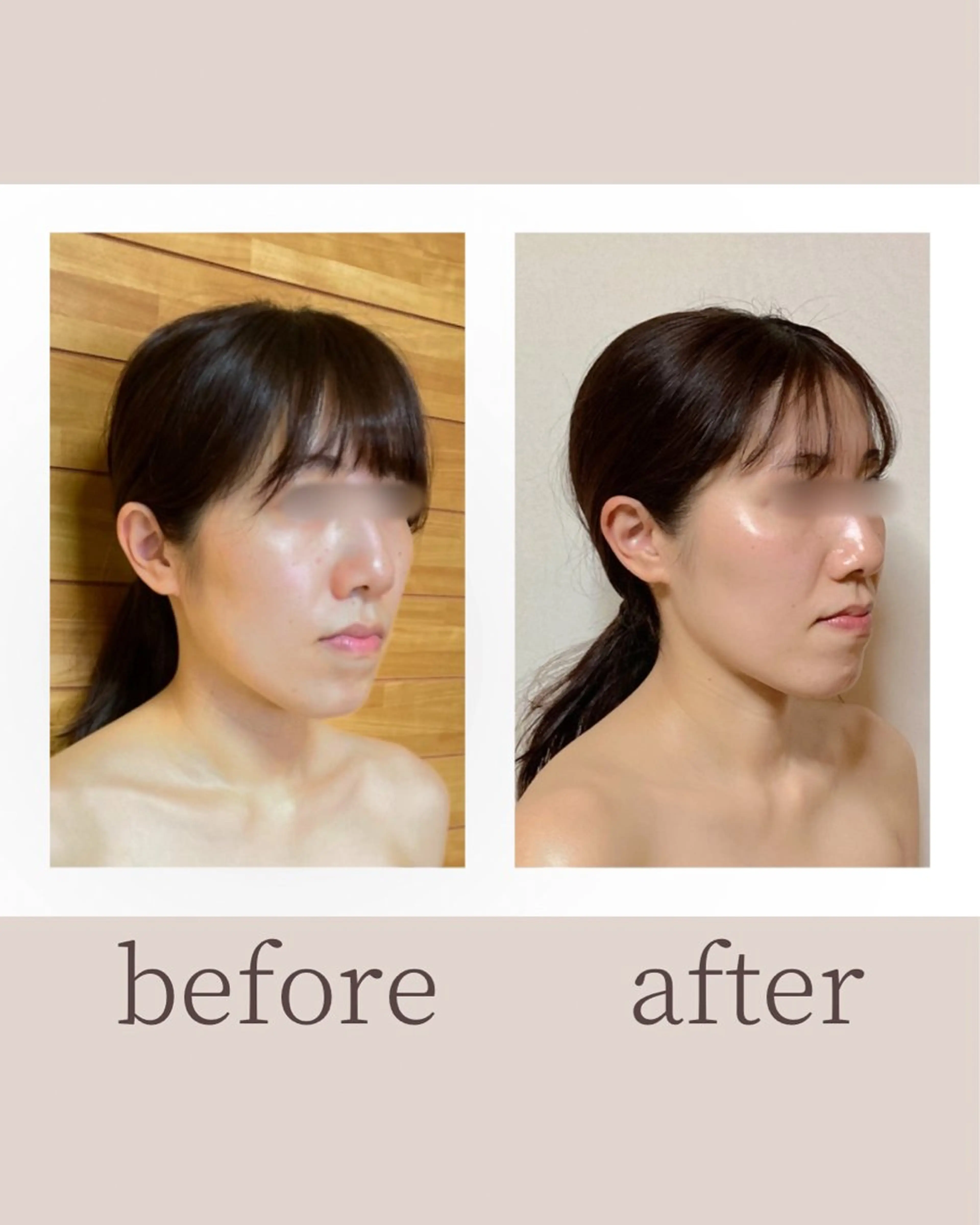 【モニター】小顔ケア+低刺激ピーリング〈ダクトピール〉の写真