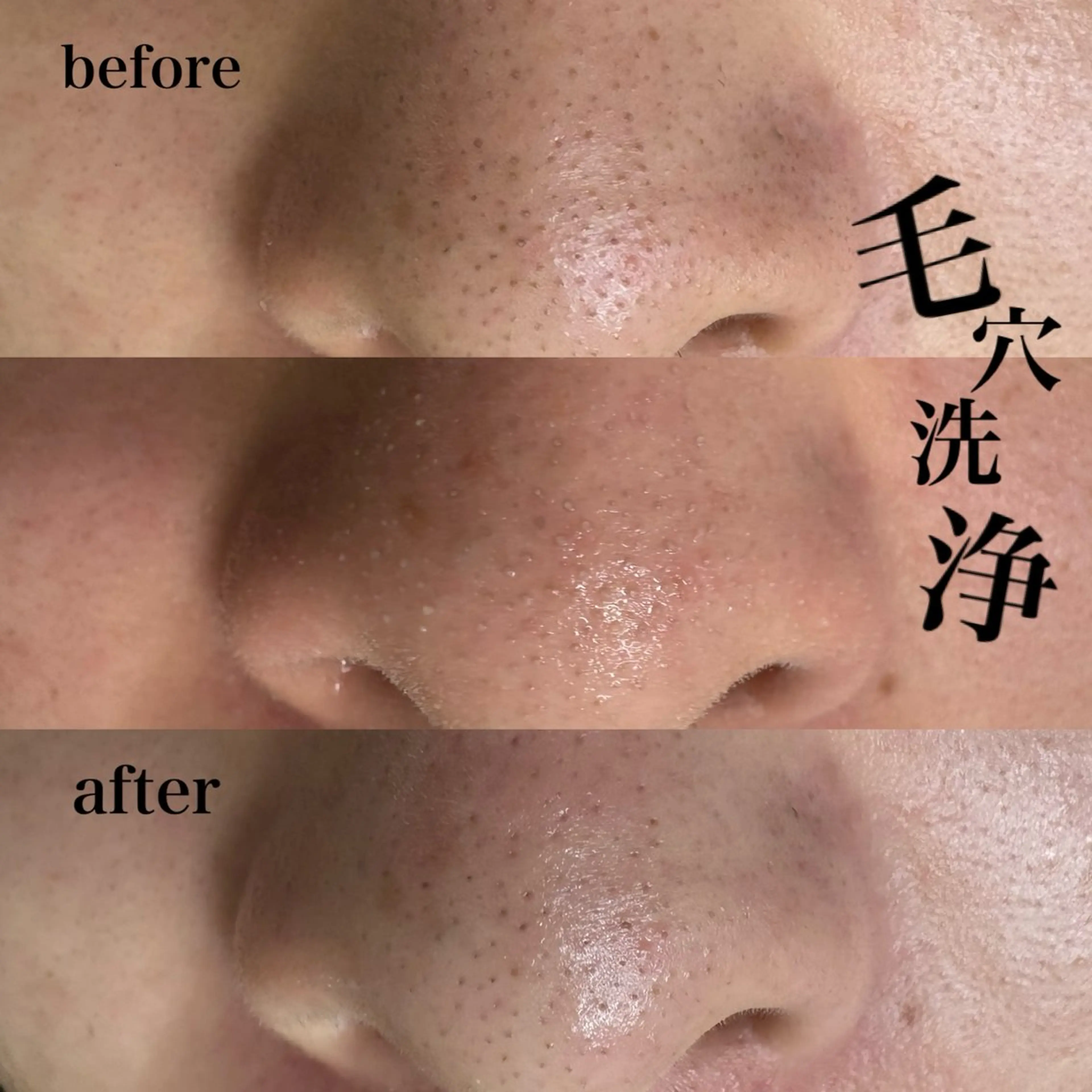 【毛穴黒ずみ撃退💥】韓国式美肌毛穴洗浄 -全顔-の写真