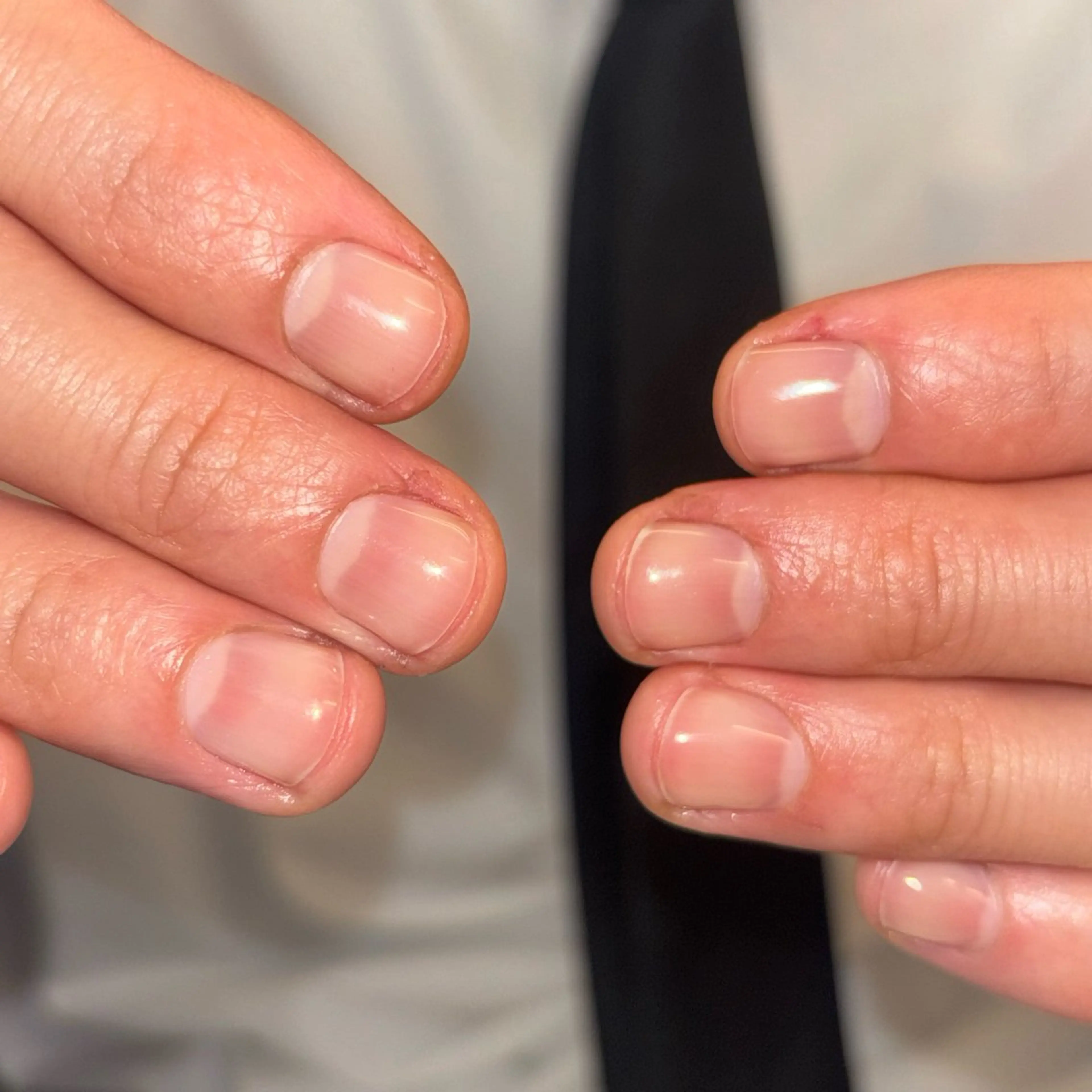 自爪風クリアネイルの写真