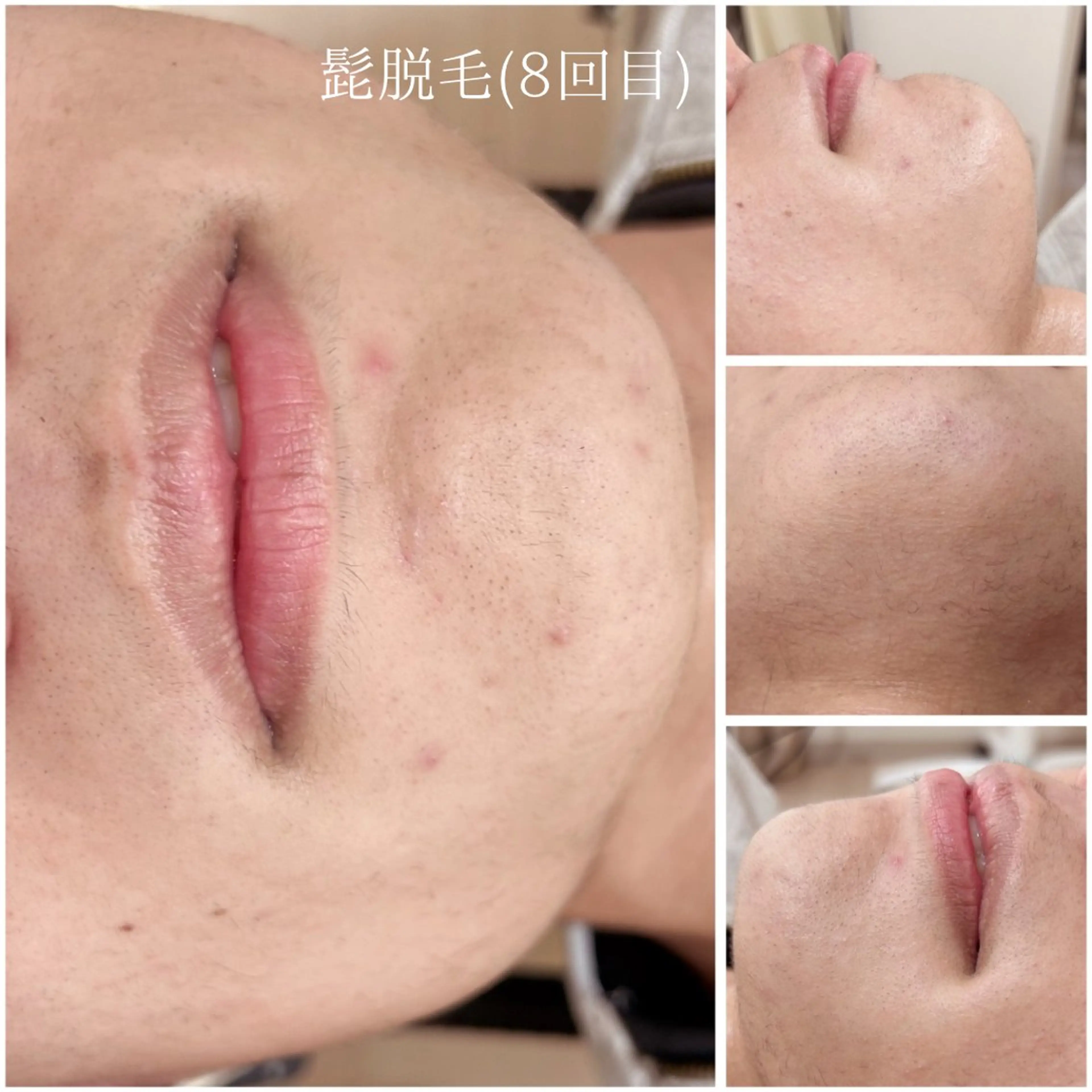 宮代・脱毛サロンMIIN所属・脱毛/ホワイトニング 美白ケア🫧MIINのエステ・リラクイメージ