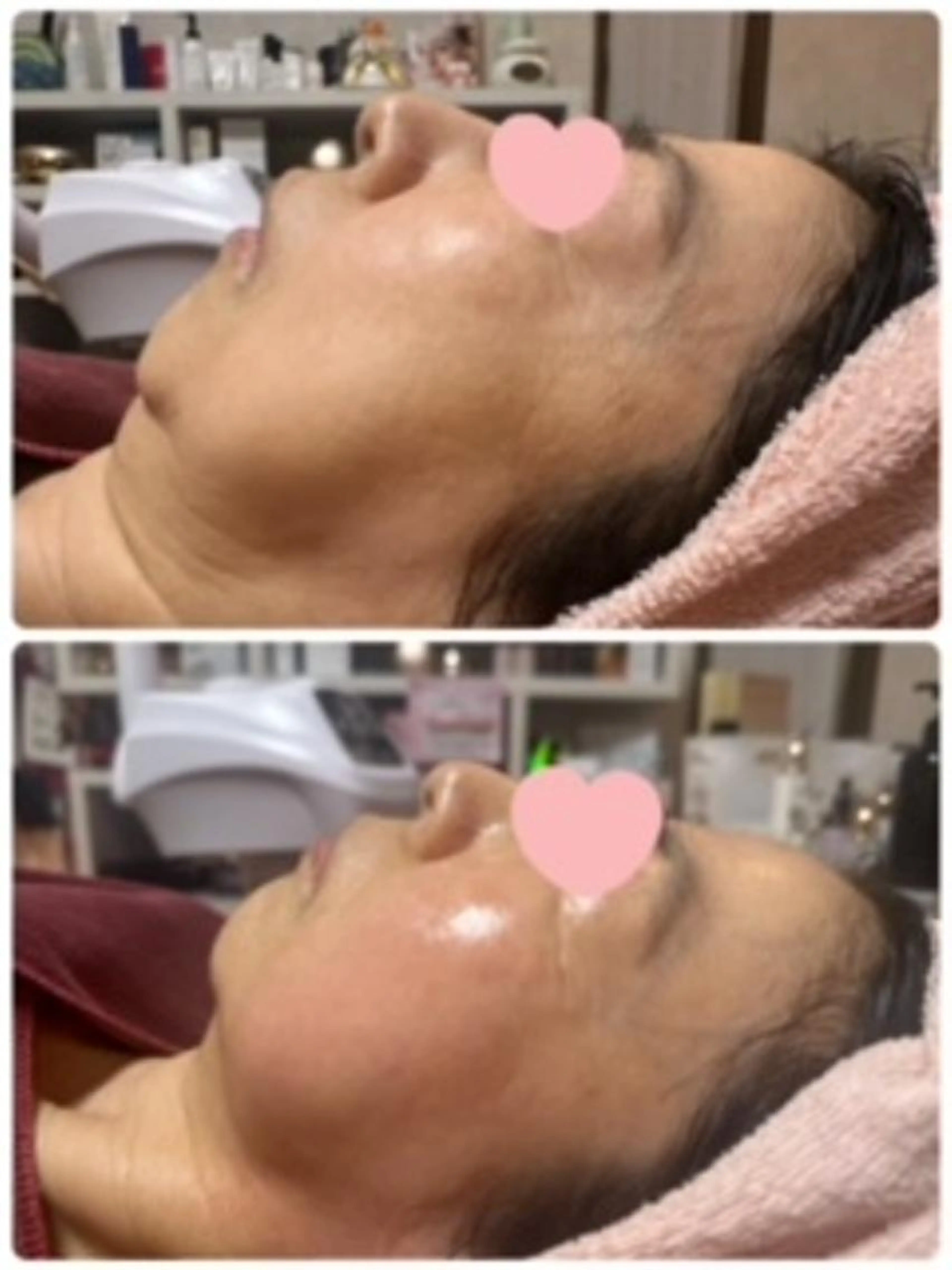 紫外線ダメージからお肌を戻すコース　美白ケアの写真
