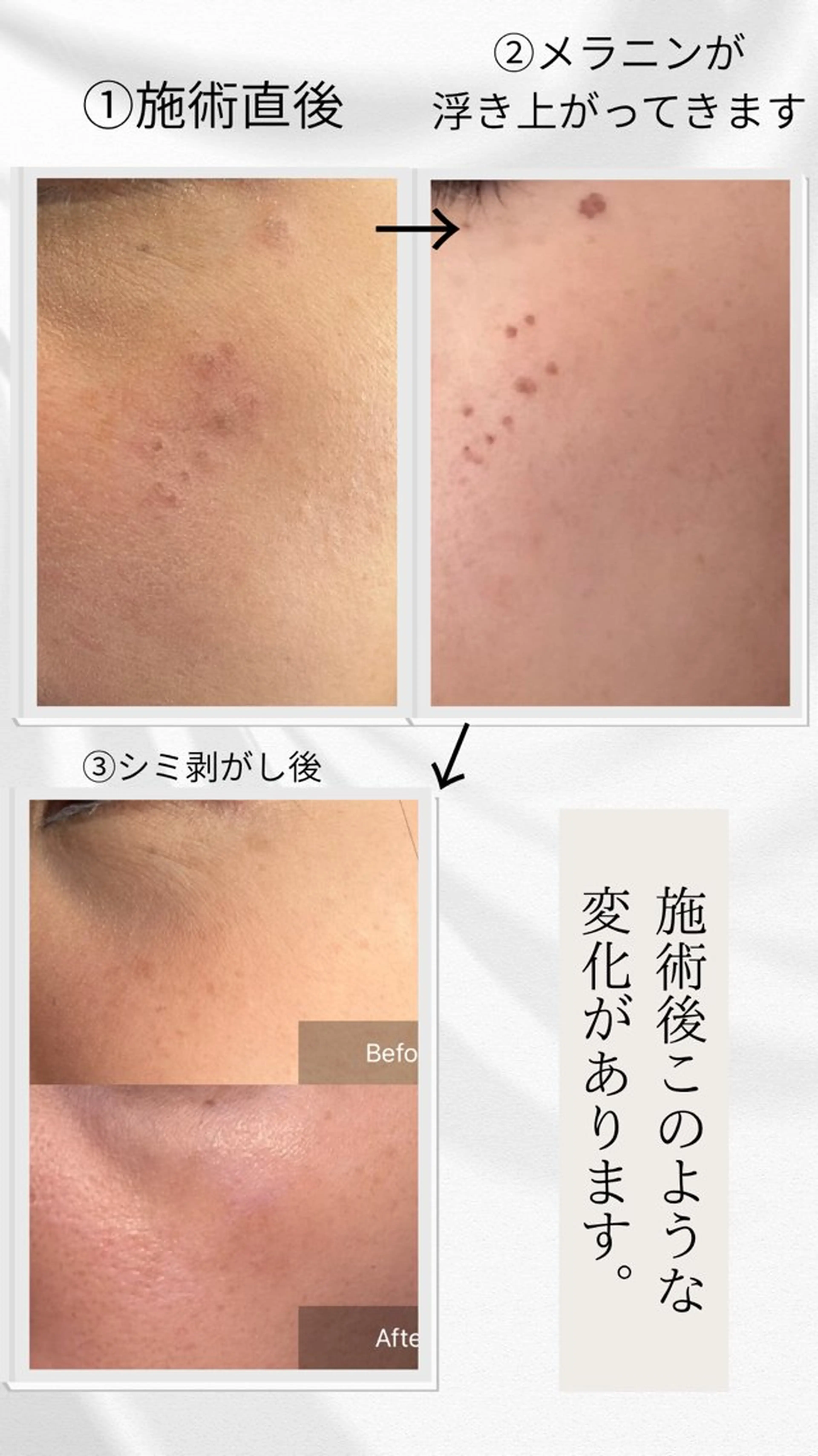 7日間の剥がれるシミケアの写真