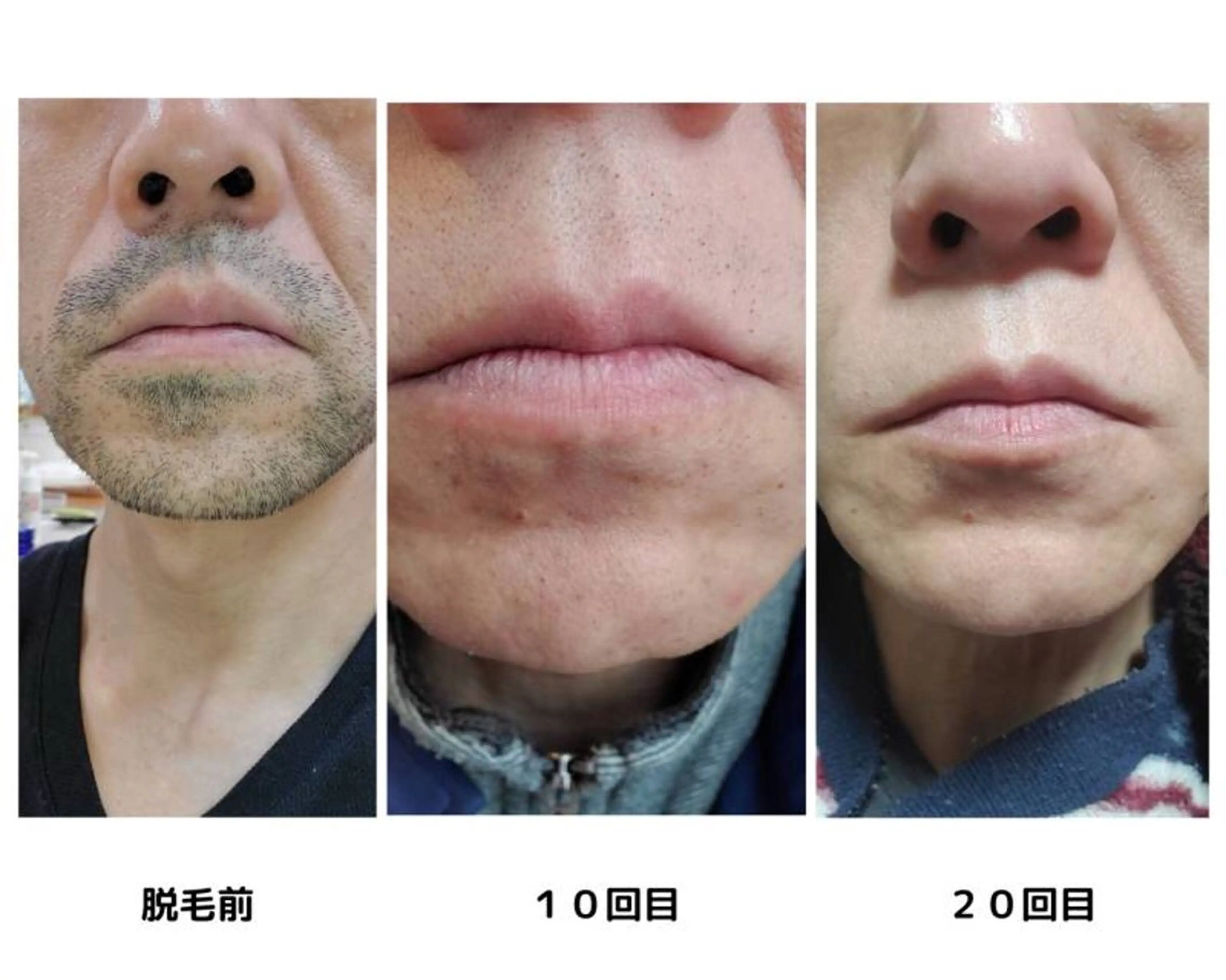 【メンズ髭脱毛】スキンケア付きだからお肌もスッキリ✨の写真
