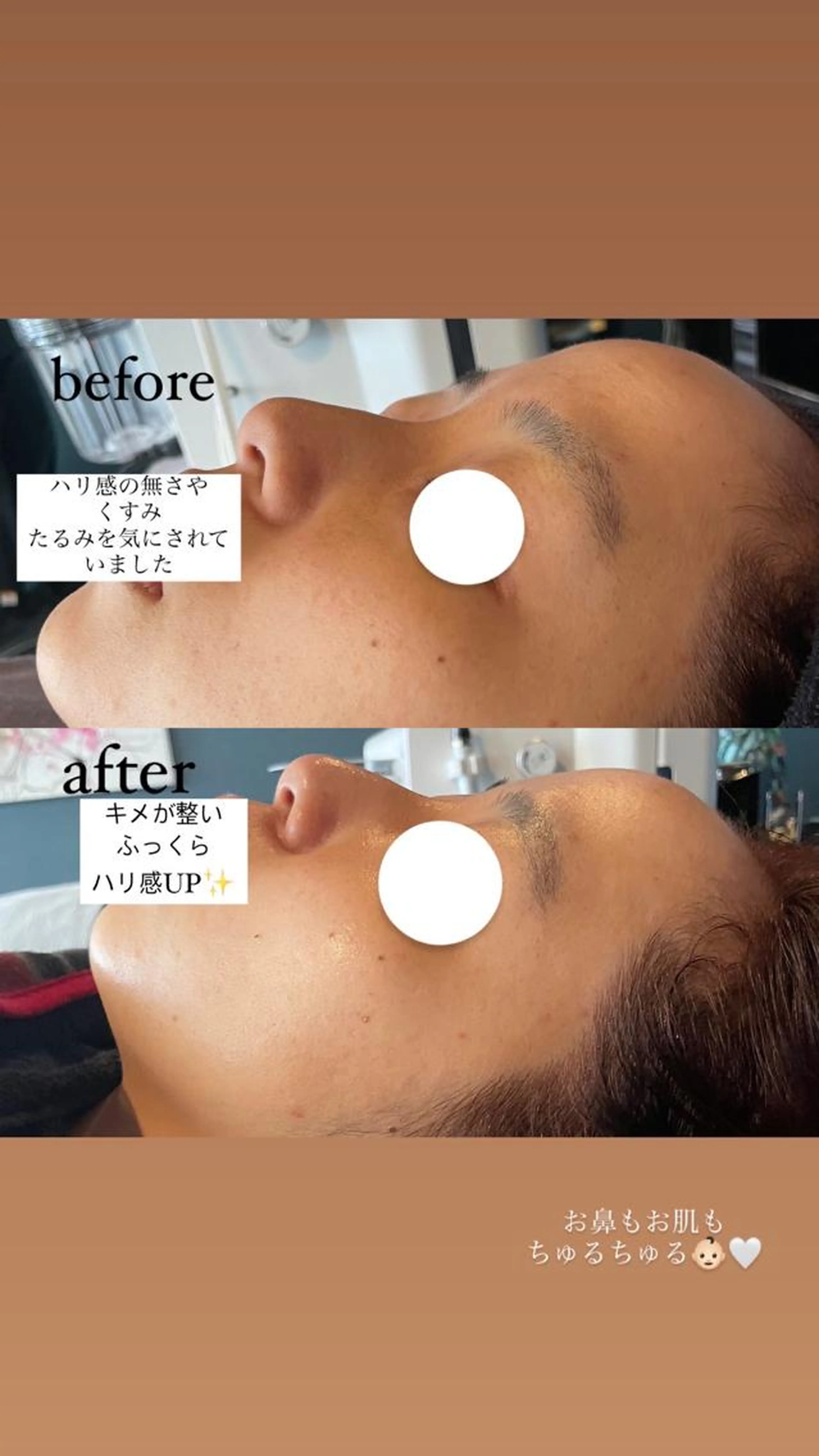 ご新規様限定【ハイドラフェイシャル✨】毛穴洗浄＋LED光トリートメントケア🤍の写真